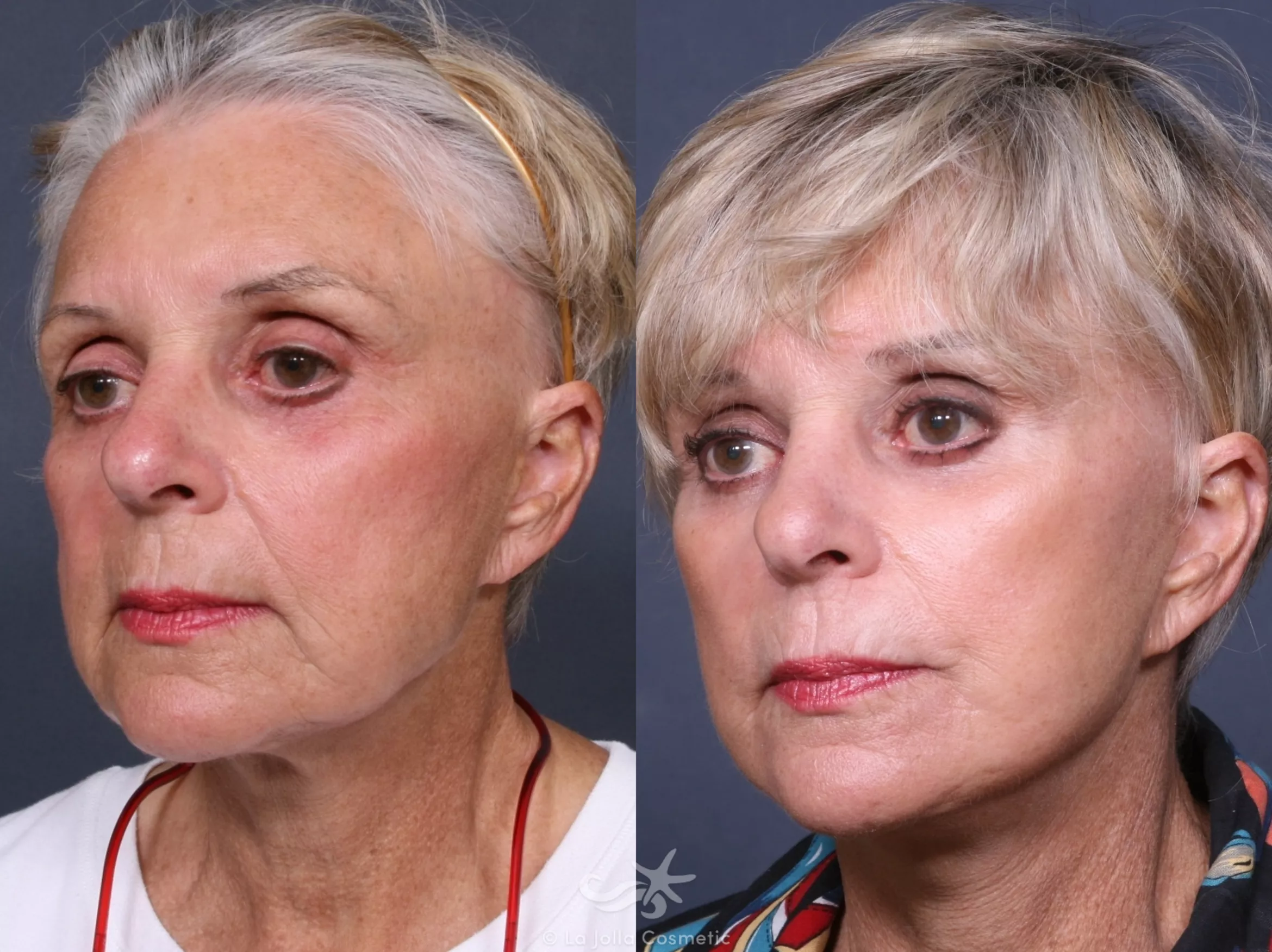 Before & After Facelift Result 324 Left Oblique View in San Diego, CA
