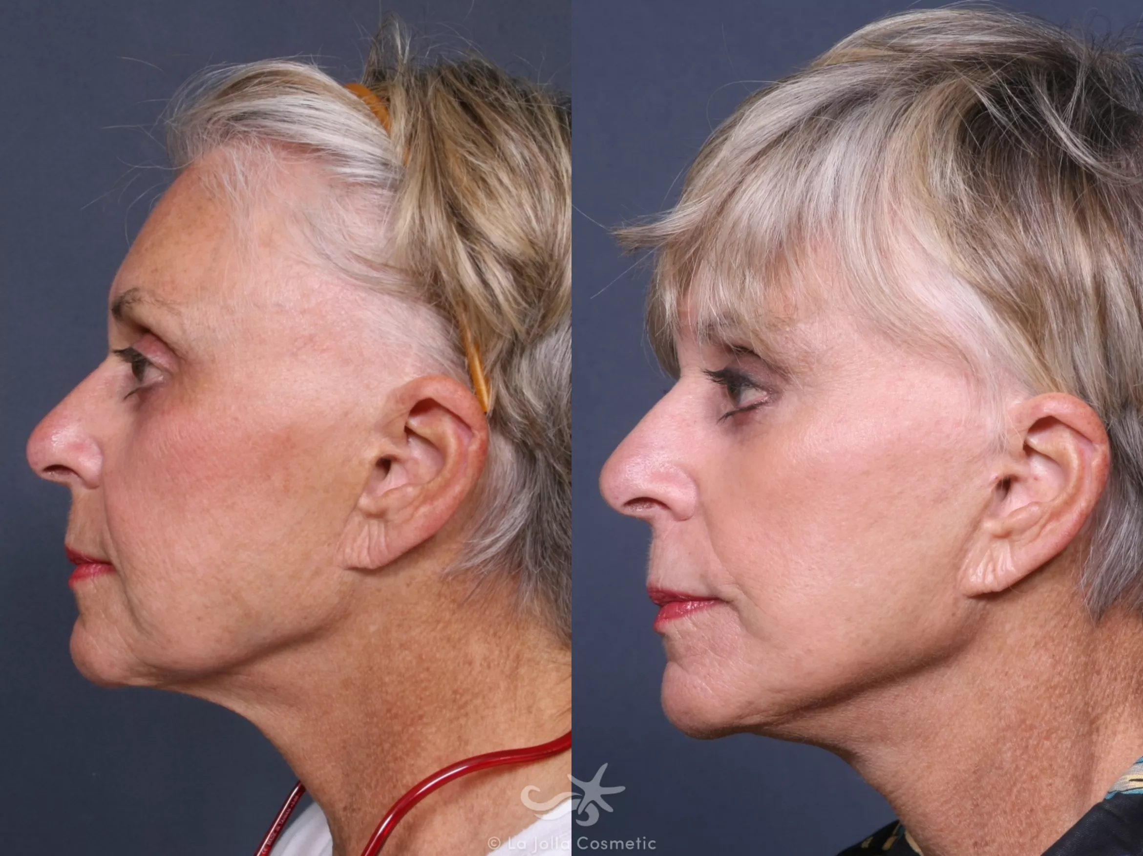 Before & After Facelift Result 324 Left Side View in San Diego, CA