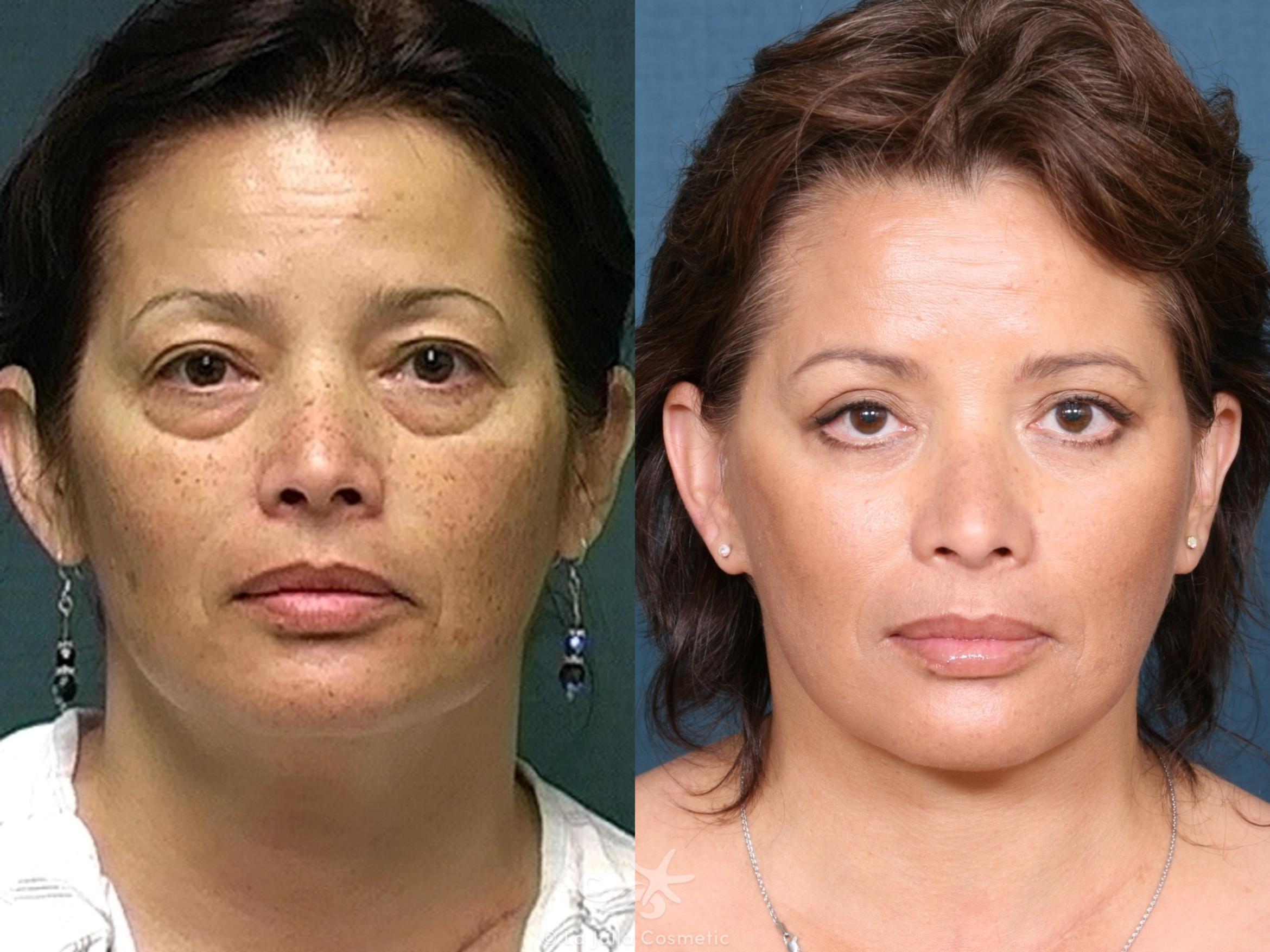 Before & After Facelift Result 325 Front View in San Diego, CA