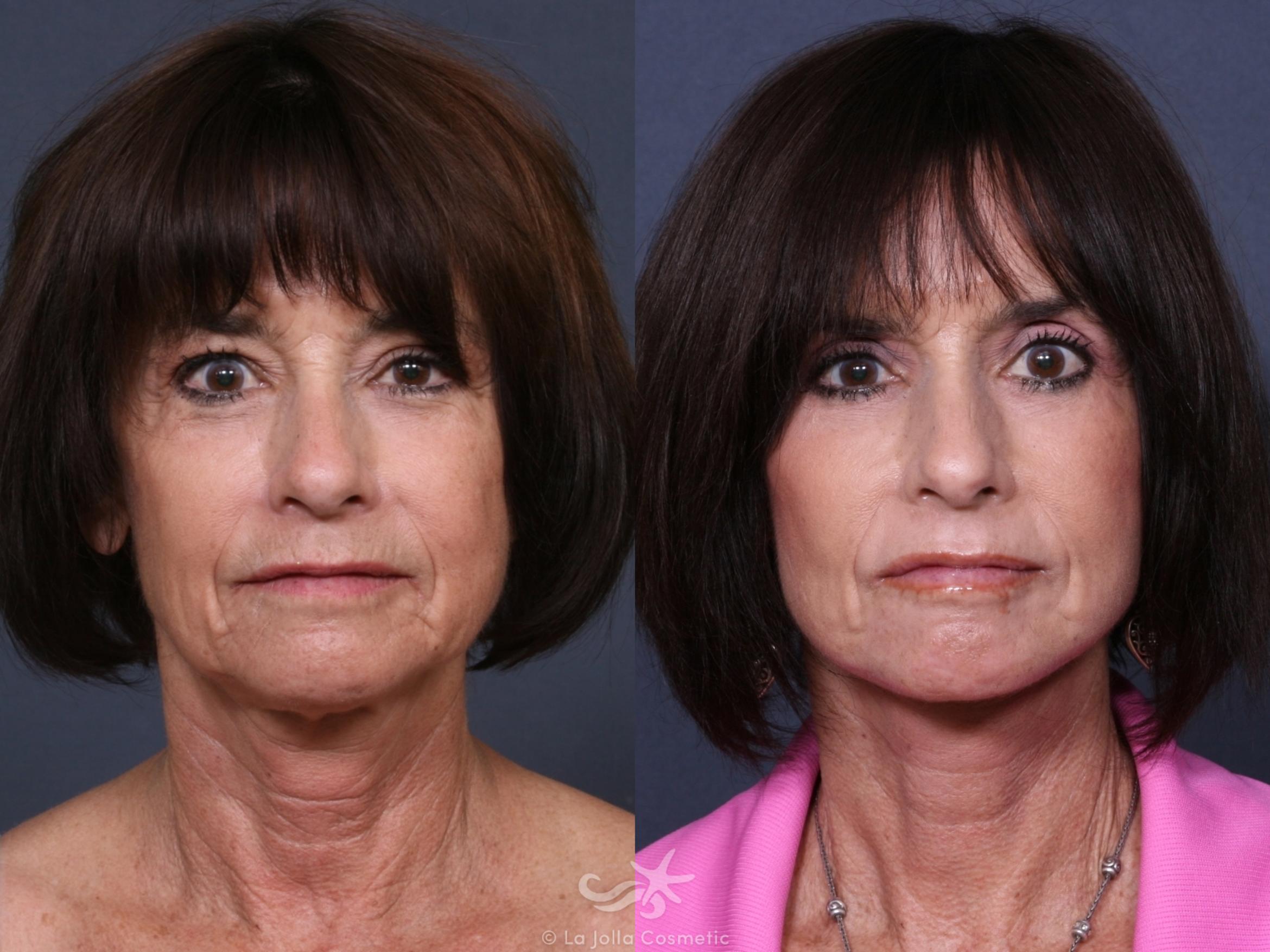Before & After Facelift Result 369 Front View in San Diego, CA