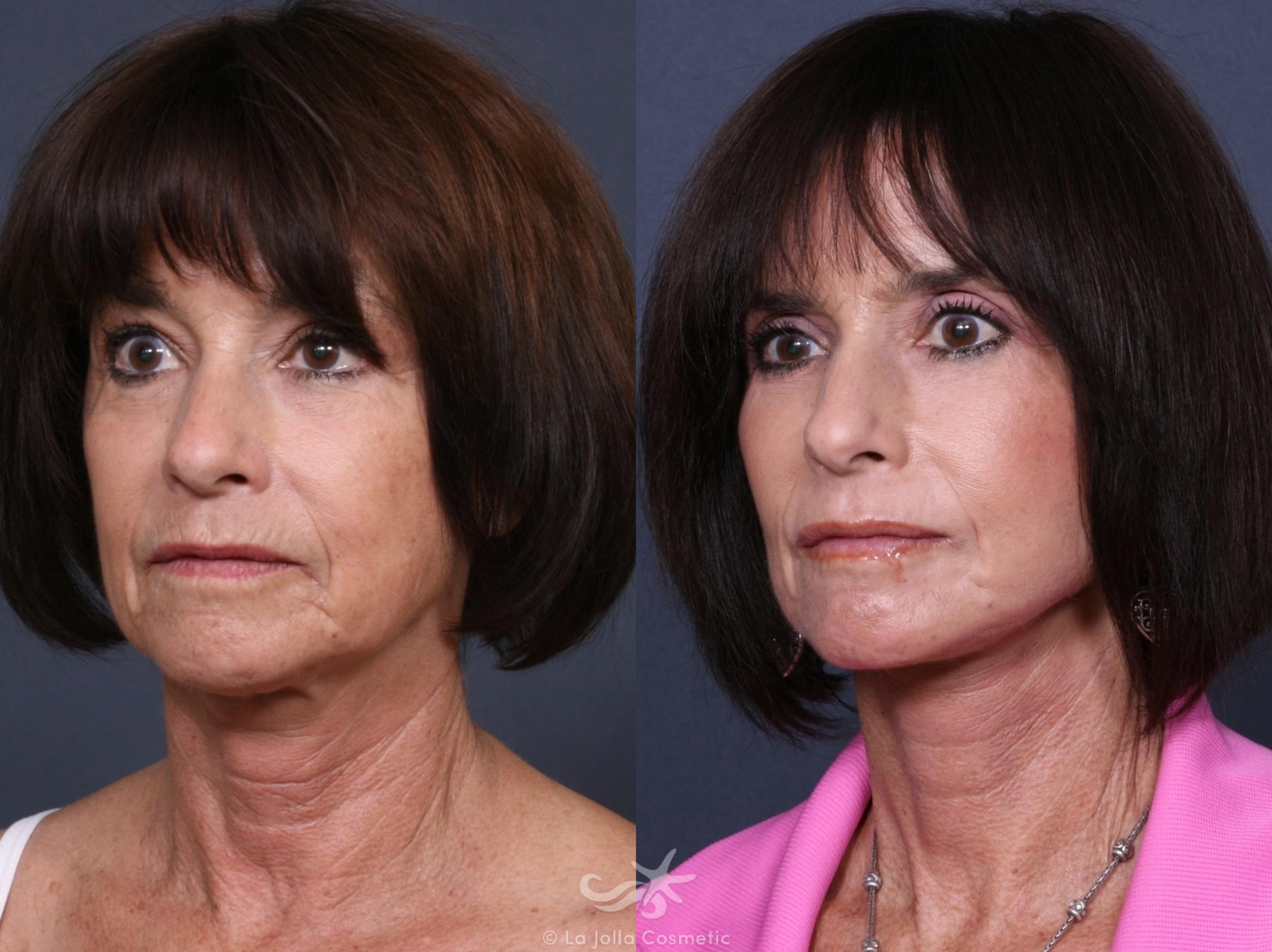 Before & After Facelift Result 369 Left Oblique View in San Diego, CA