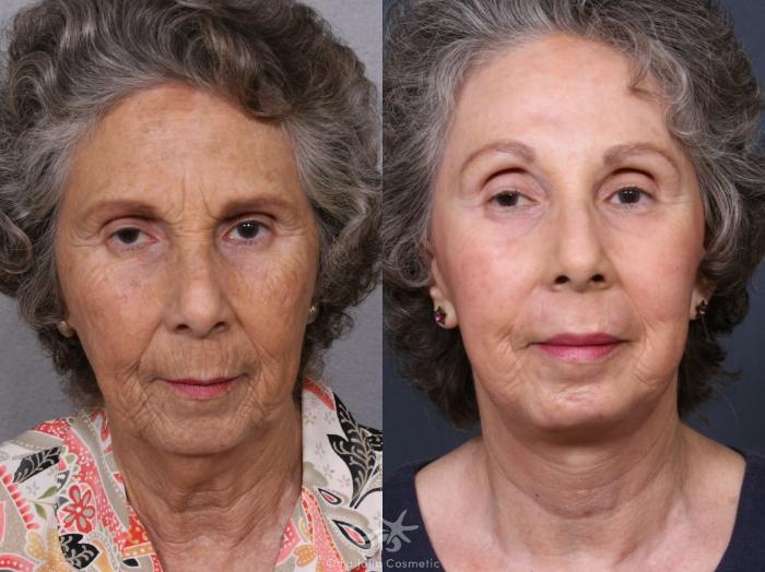 Before & After Facelift Result 372 Front View in San Diego, Carlsbad, CA