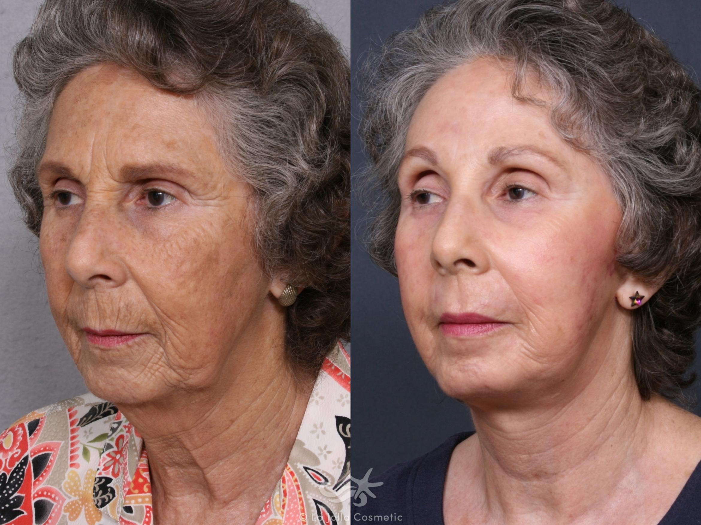 Before & After Facelift Result 372 Left Oblique View in San Diego, CA
