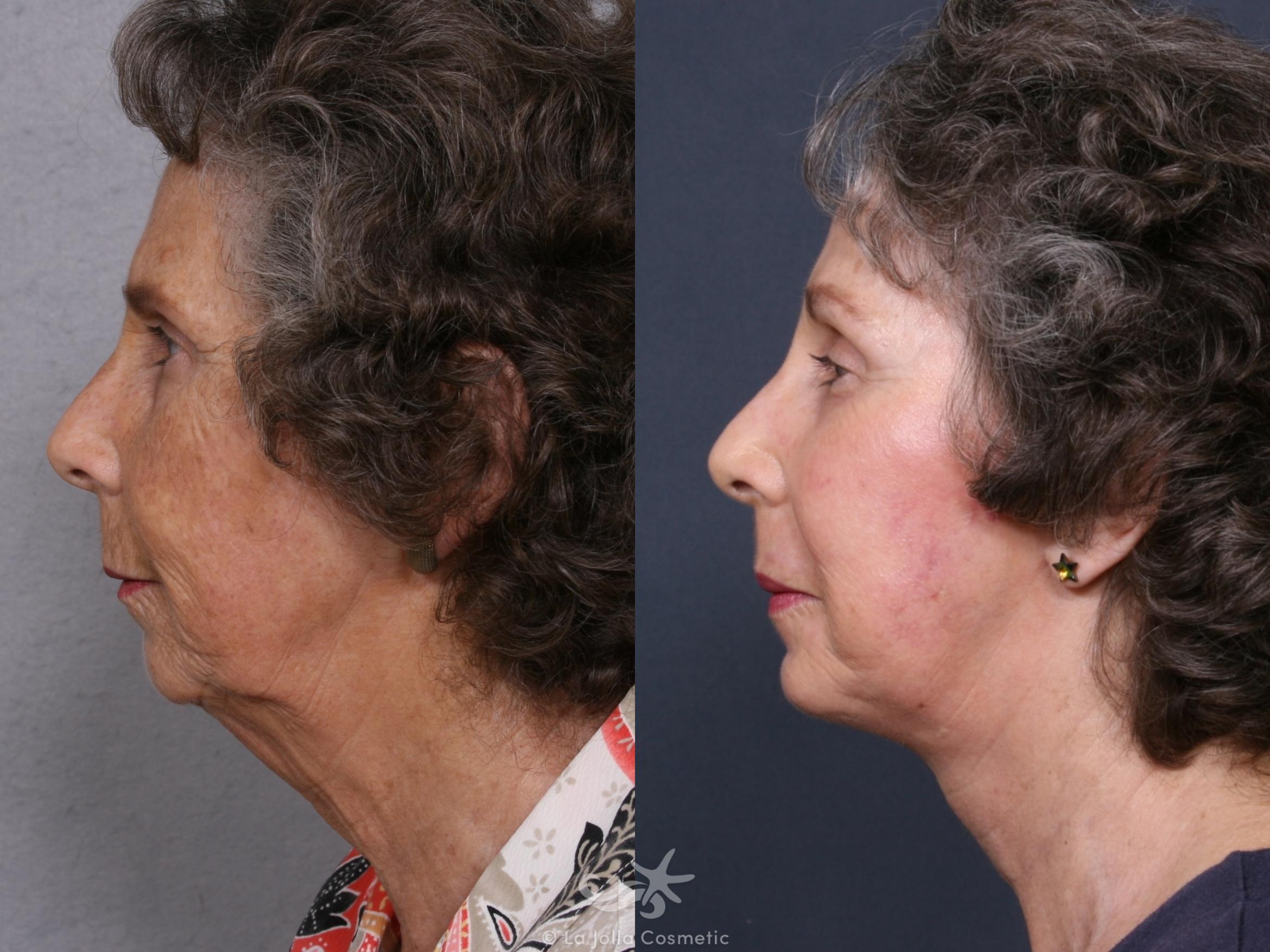 Before & After Facelift Result 372 Left Side View in San Diego, CA