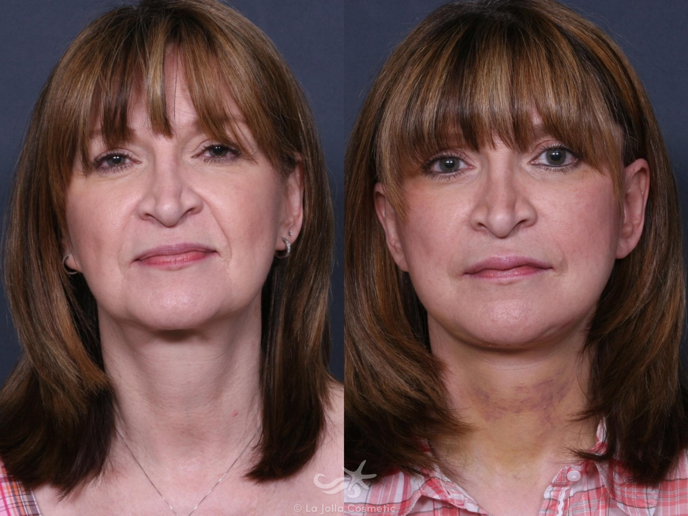 Before & After Facelift Result 401 Front View in San Diego, CA