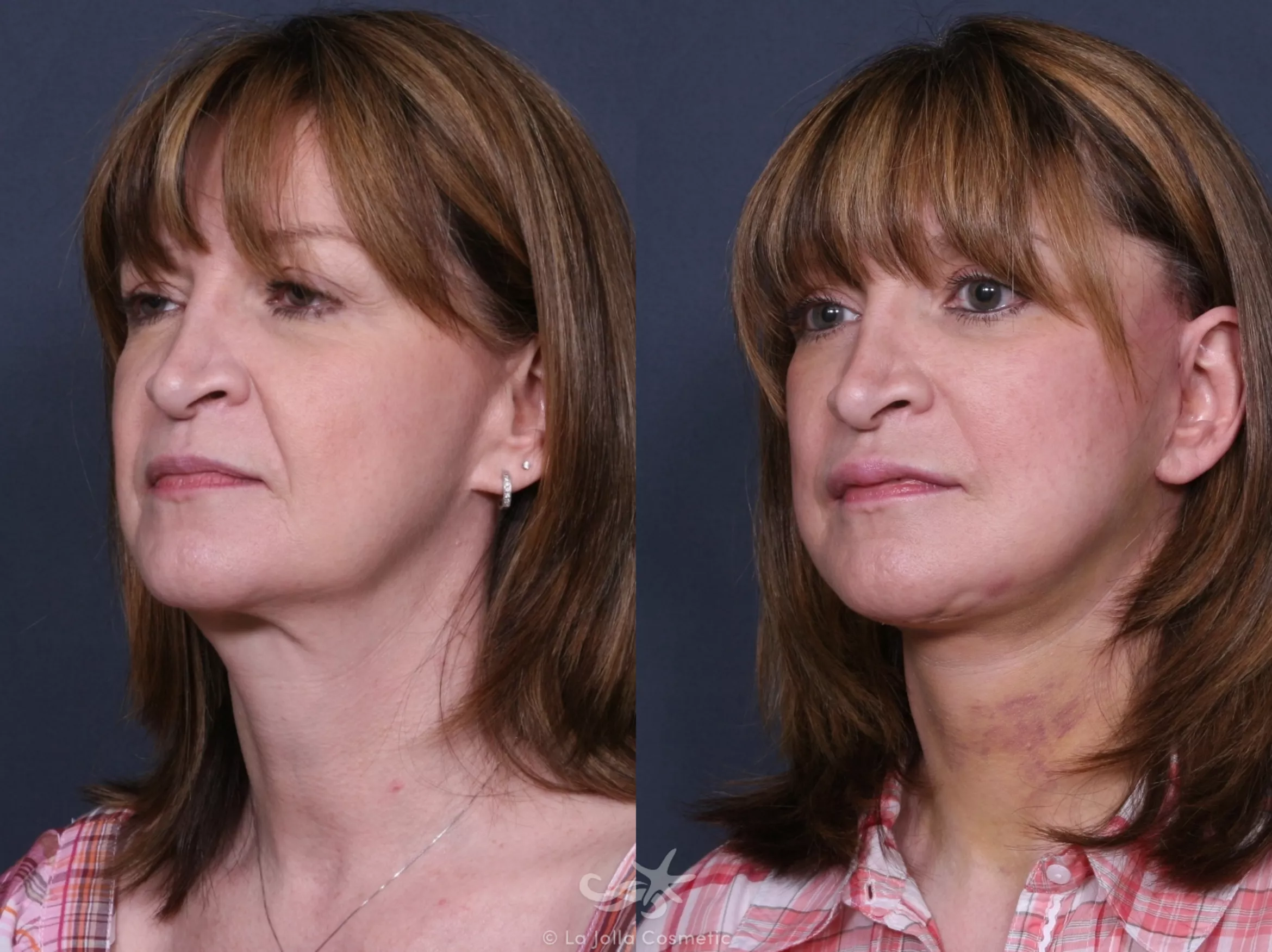 Before & After Facelift Result 401 Left Oblique View in San Diego, CA