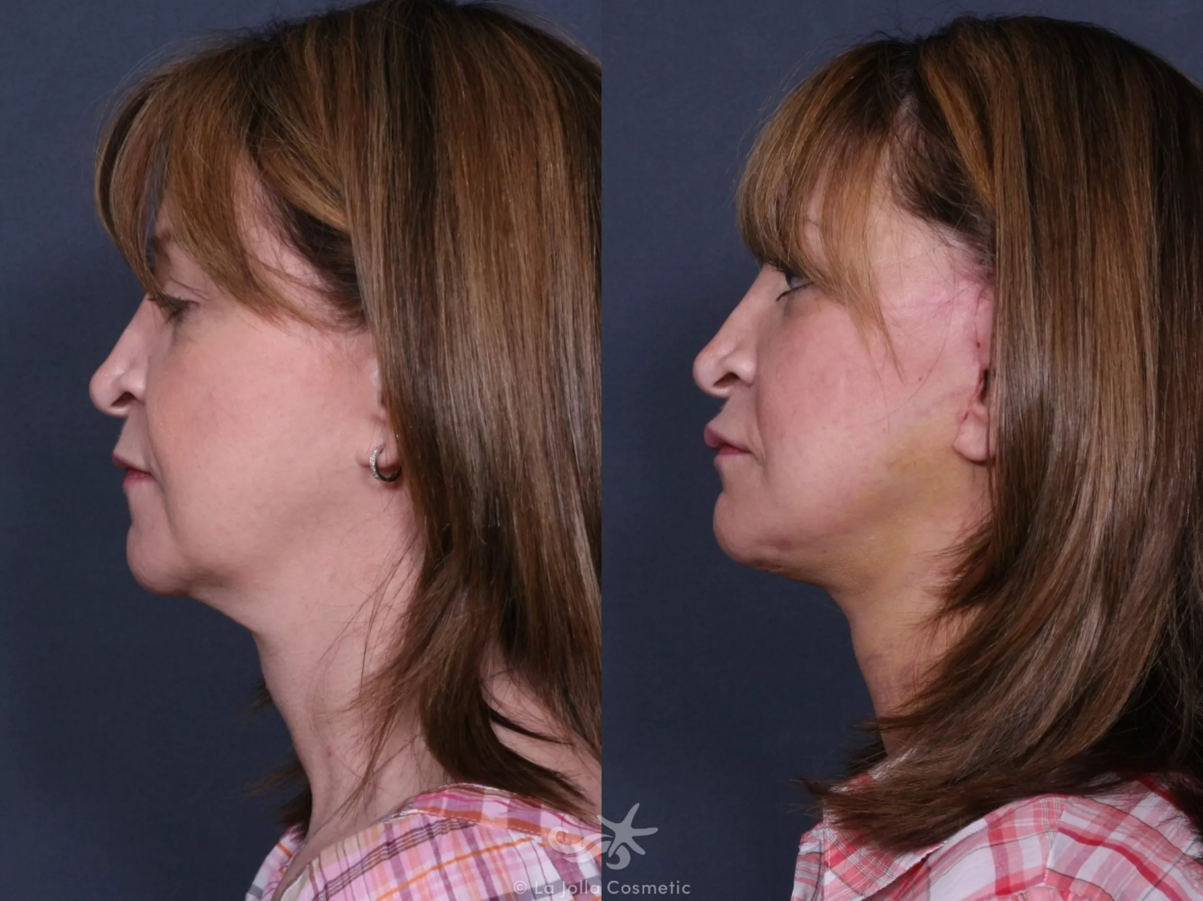 Before & After Facelift Result 401 Left Side View in San Diego, CA