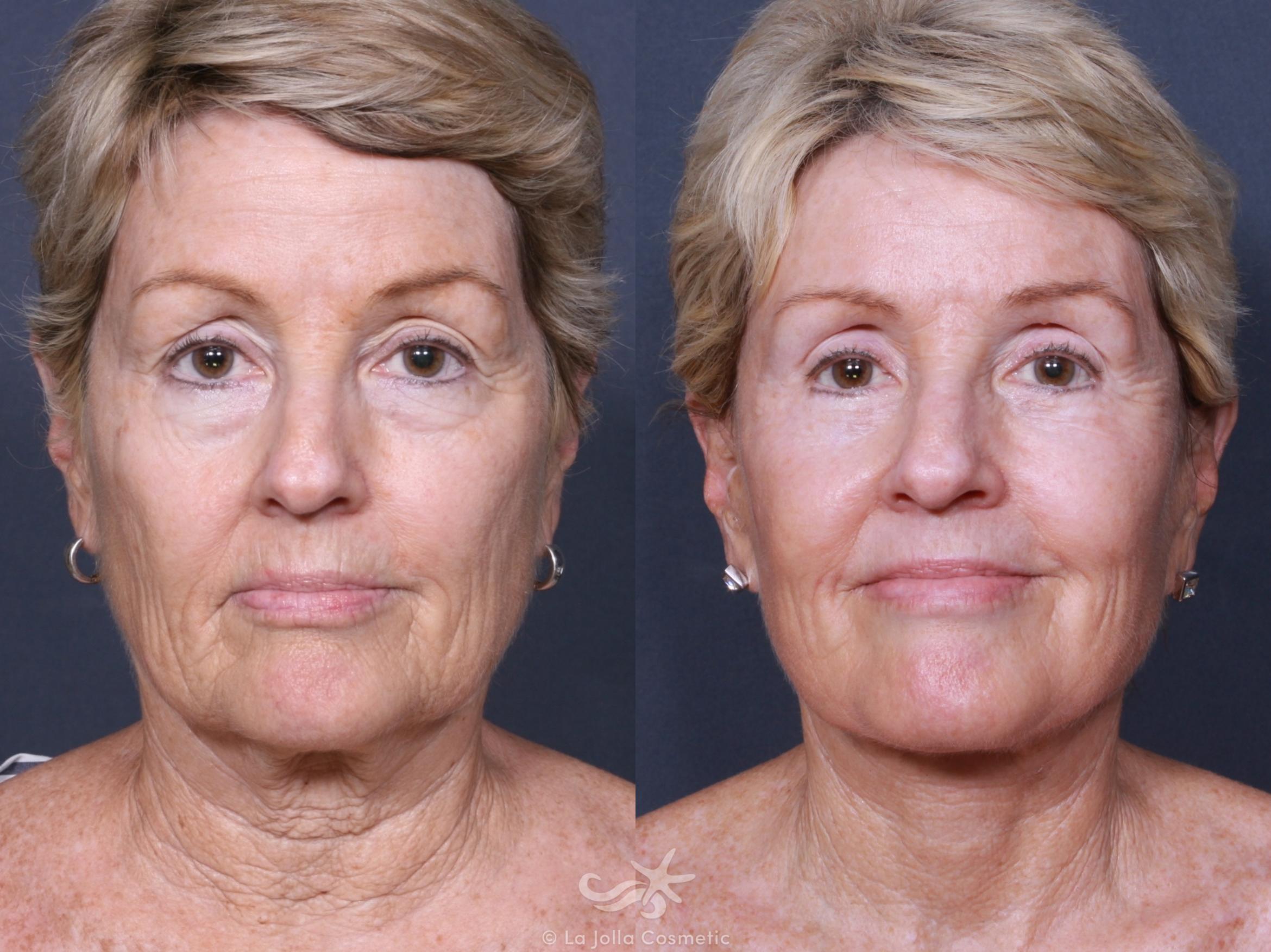Before & After Eyelid Lift Result 457 Front View in San Diego, CA