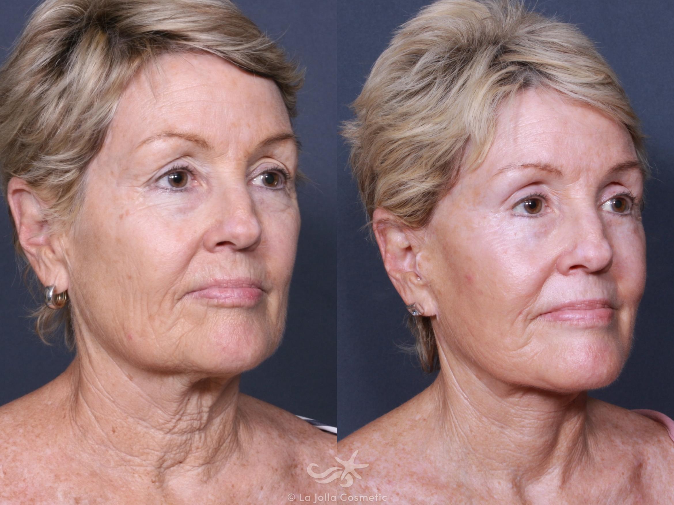 Before & After Eyelid Lift Result 457 Right Oblique View in San Diego, CA