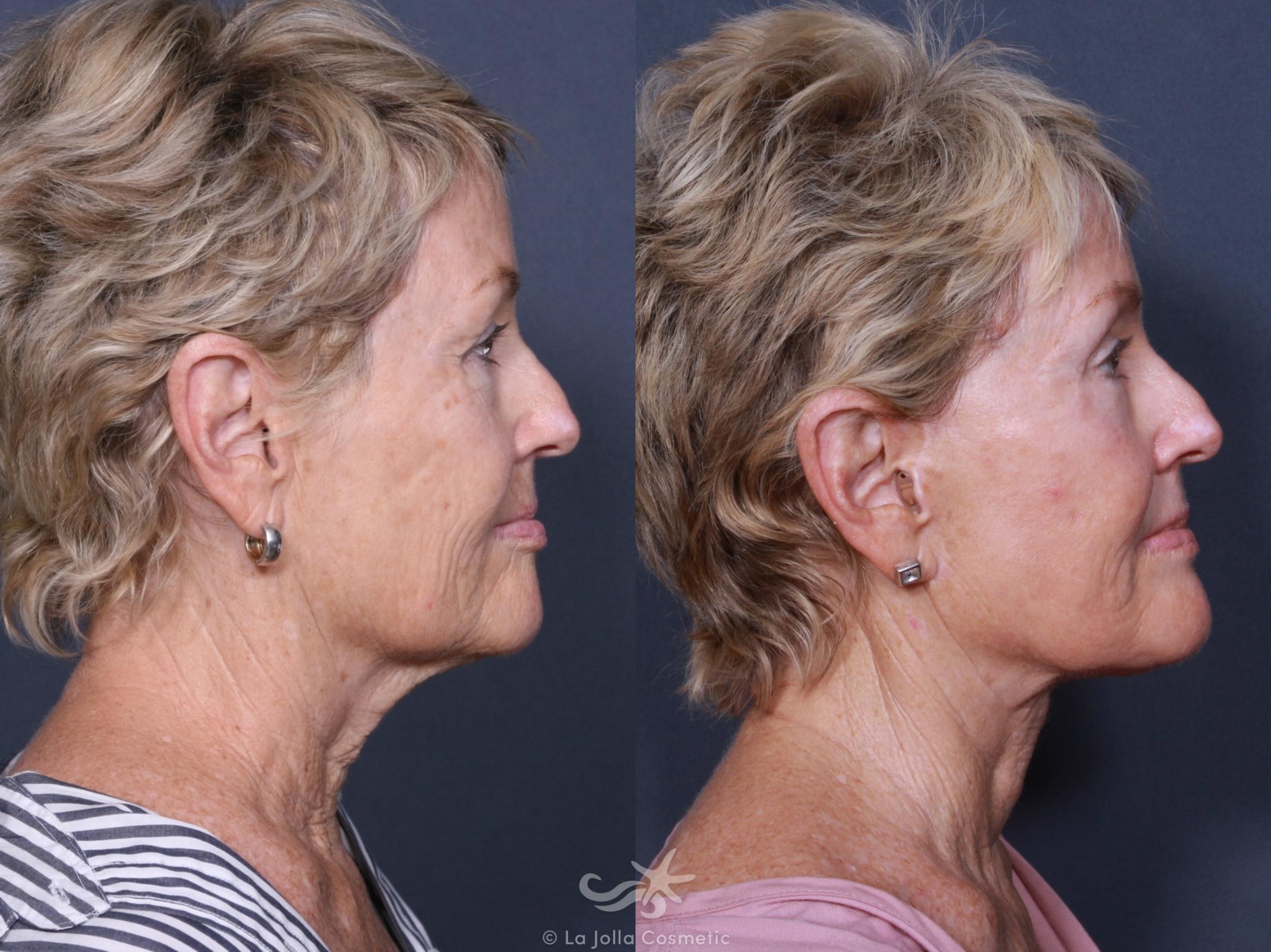 Before & After Eyelid Lift Result 457 Right Side View in San Diego, CA