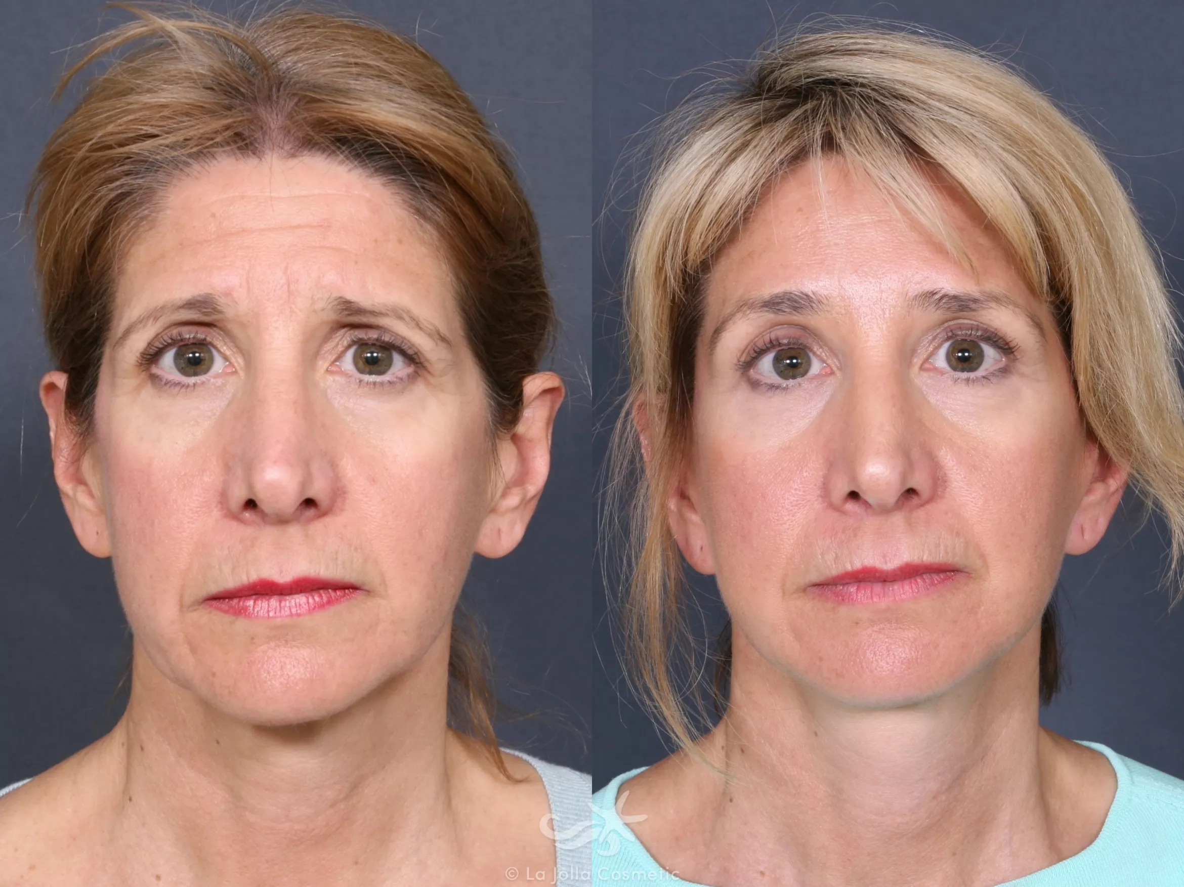 Before & After Facelift Result 463 Front View in San Diego, CA