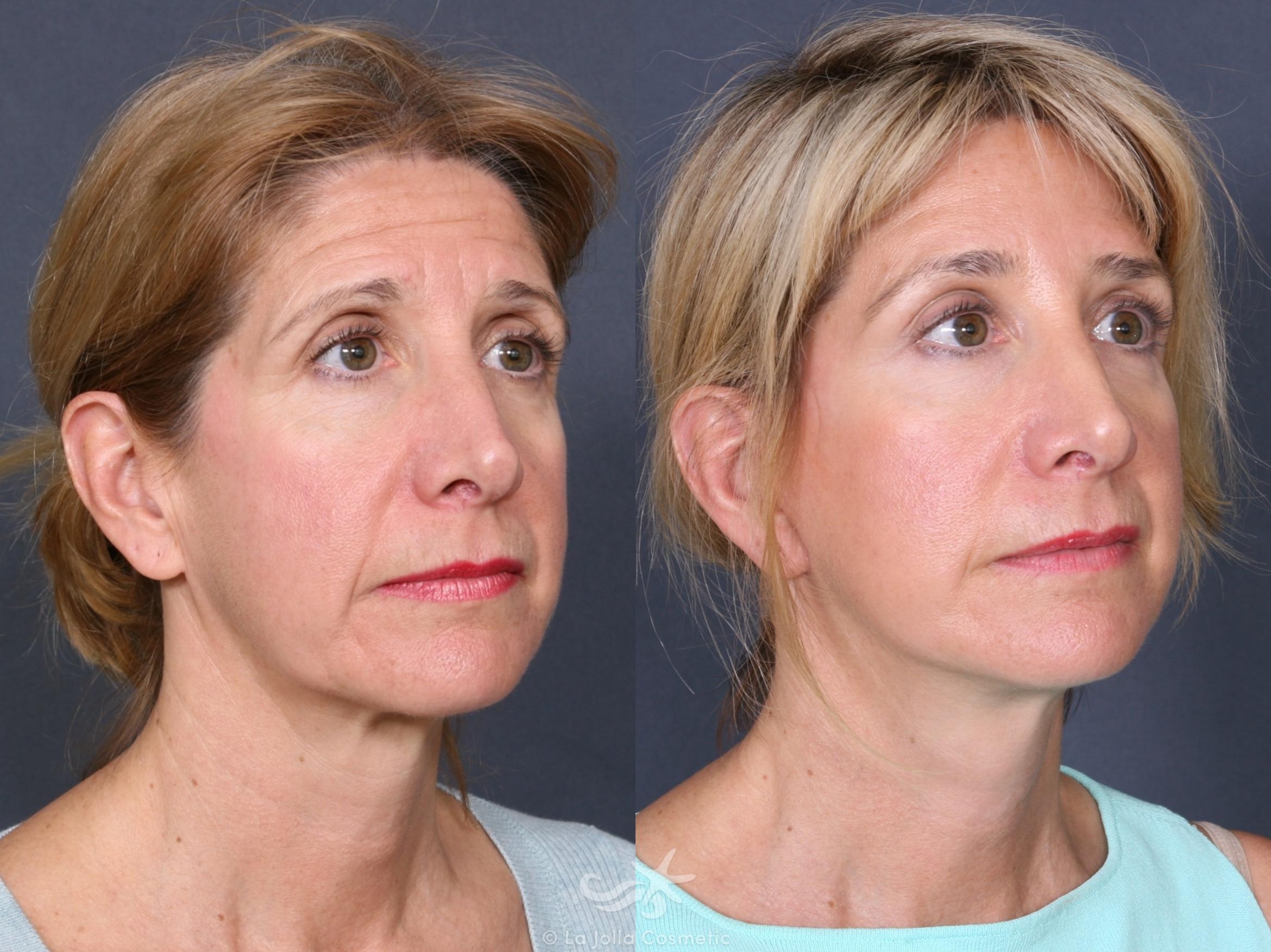 Before & After Facelift Result 463 Right Oblique View in San Diego, CA