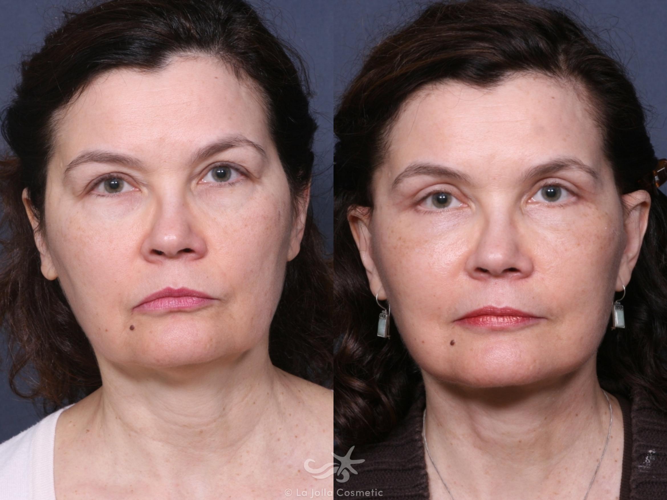 Before & After Eyelid Lift Result 467 Front View in San Diego, CA