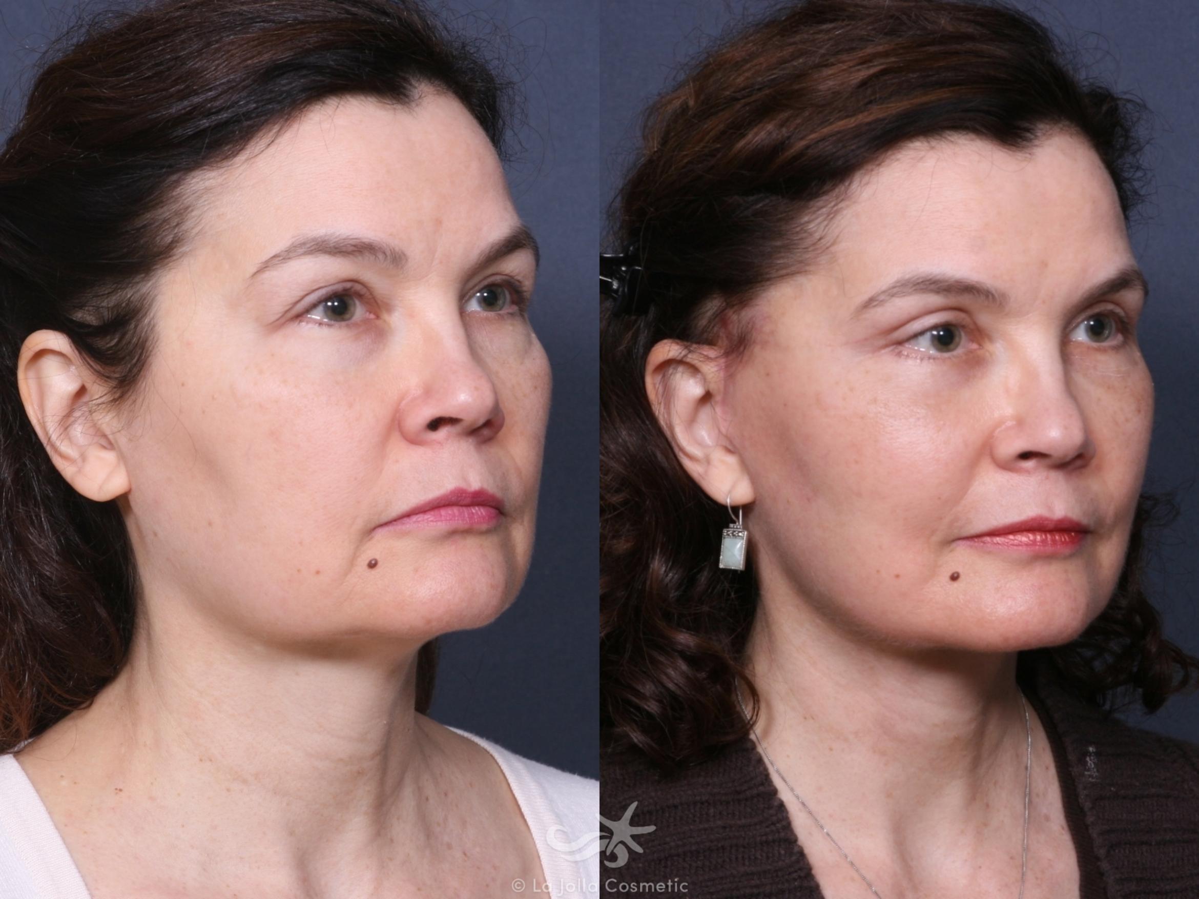 Before & After Facelift Result 467 Right Oblique View in San Diego, CA