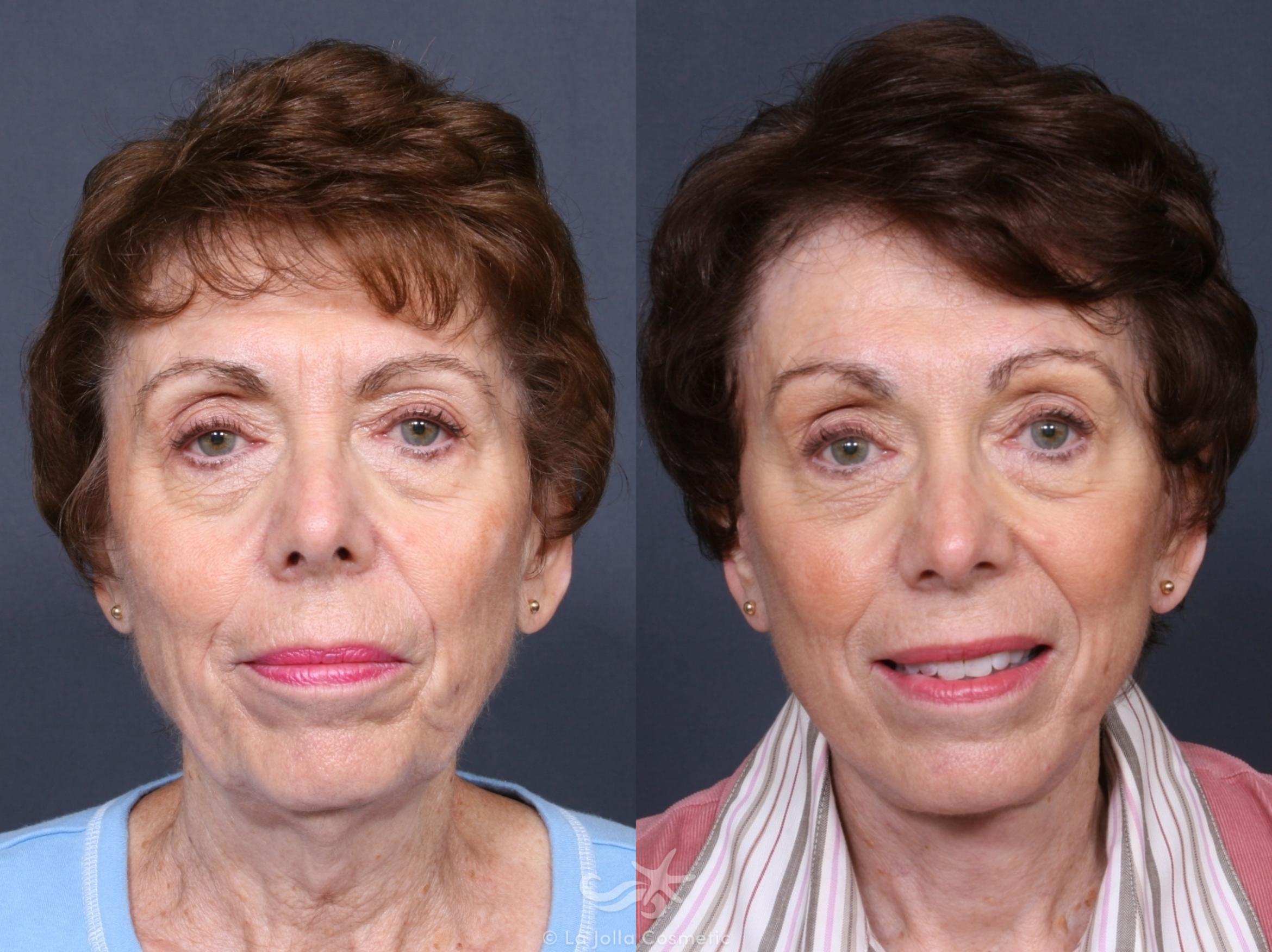 Before & After Neck Lift Result 468 Front View in San Diego, CA