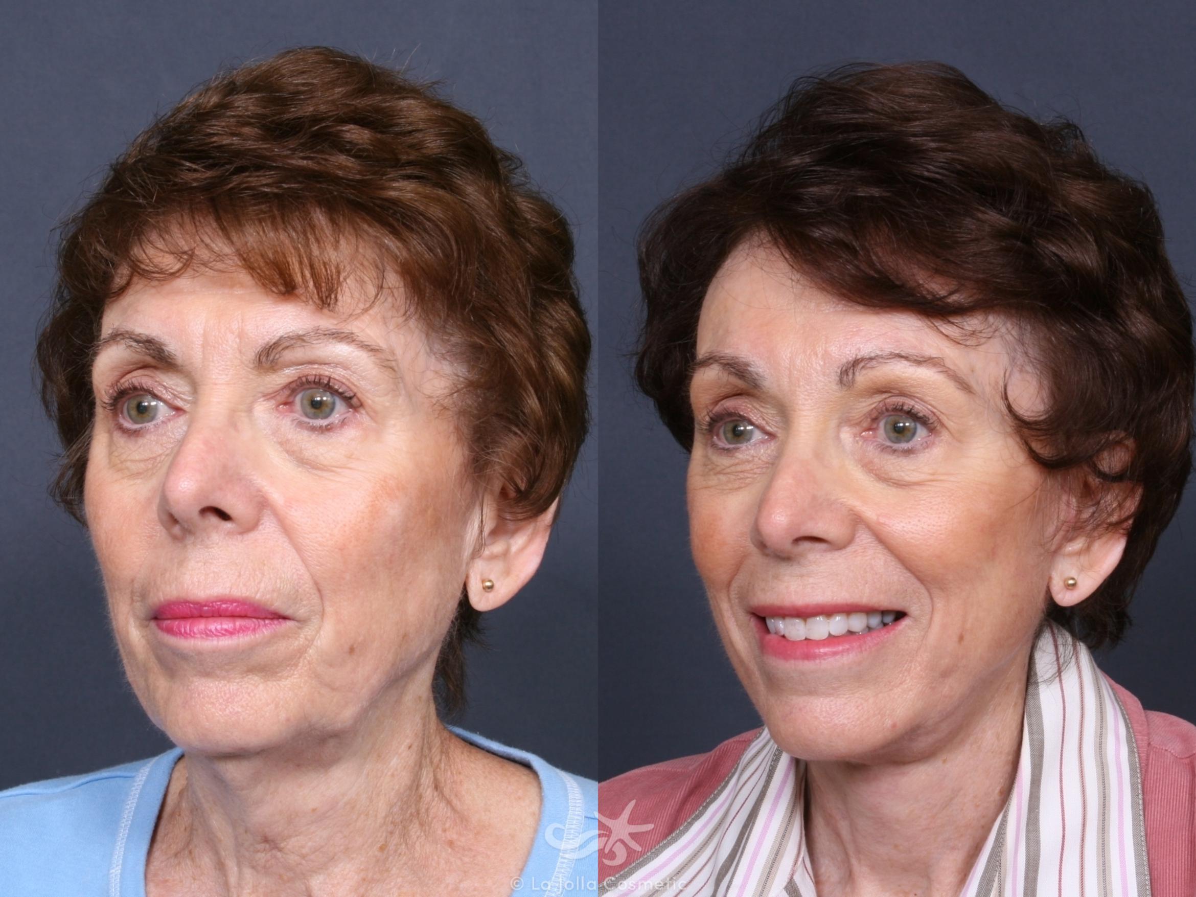 Before & After Facelift Result 468 Left Oblique View in San Diego, CA