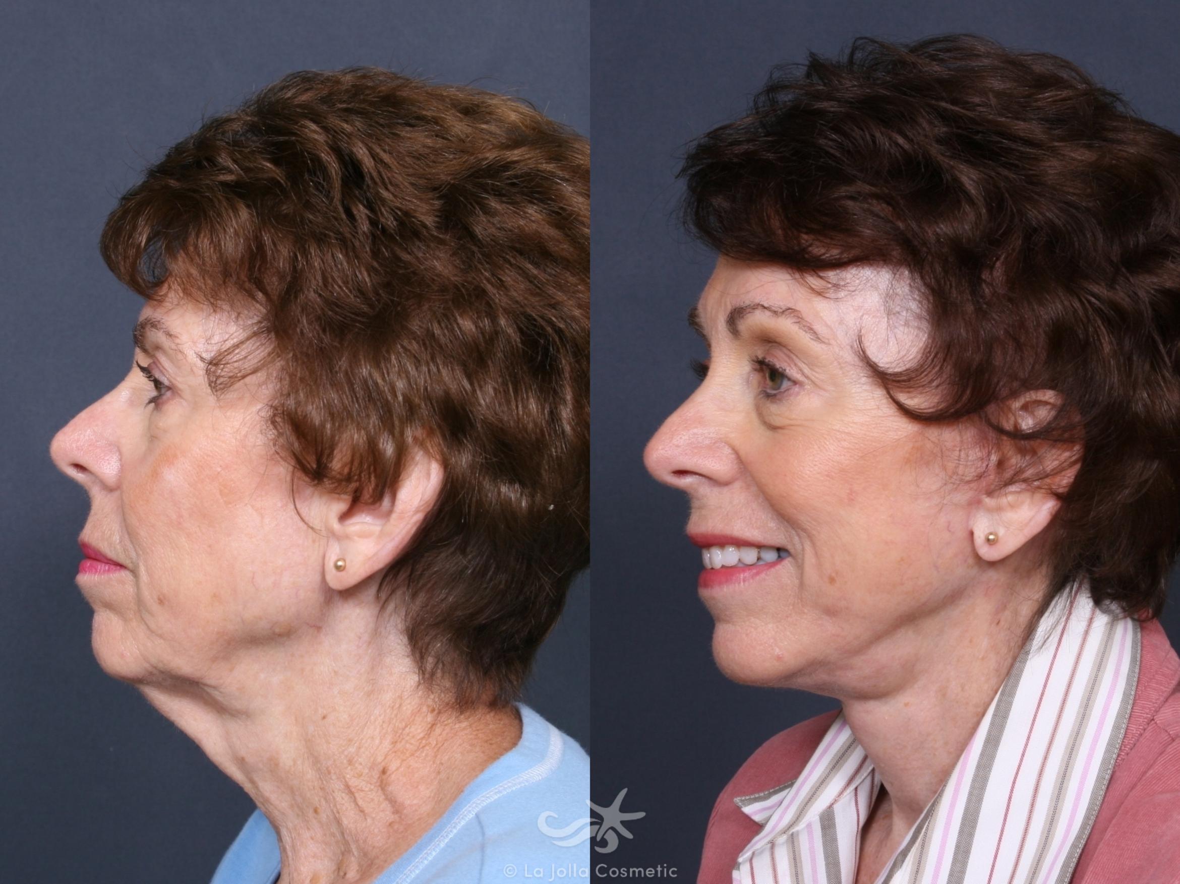 Before & After Facelift Result 468 Left Side View in San Diego, CA