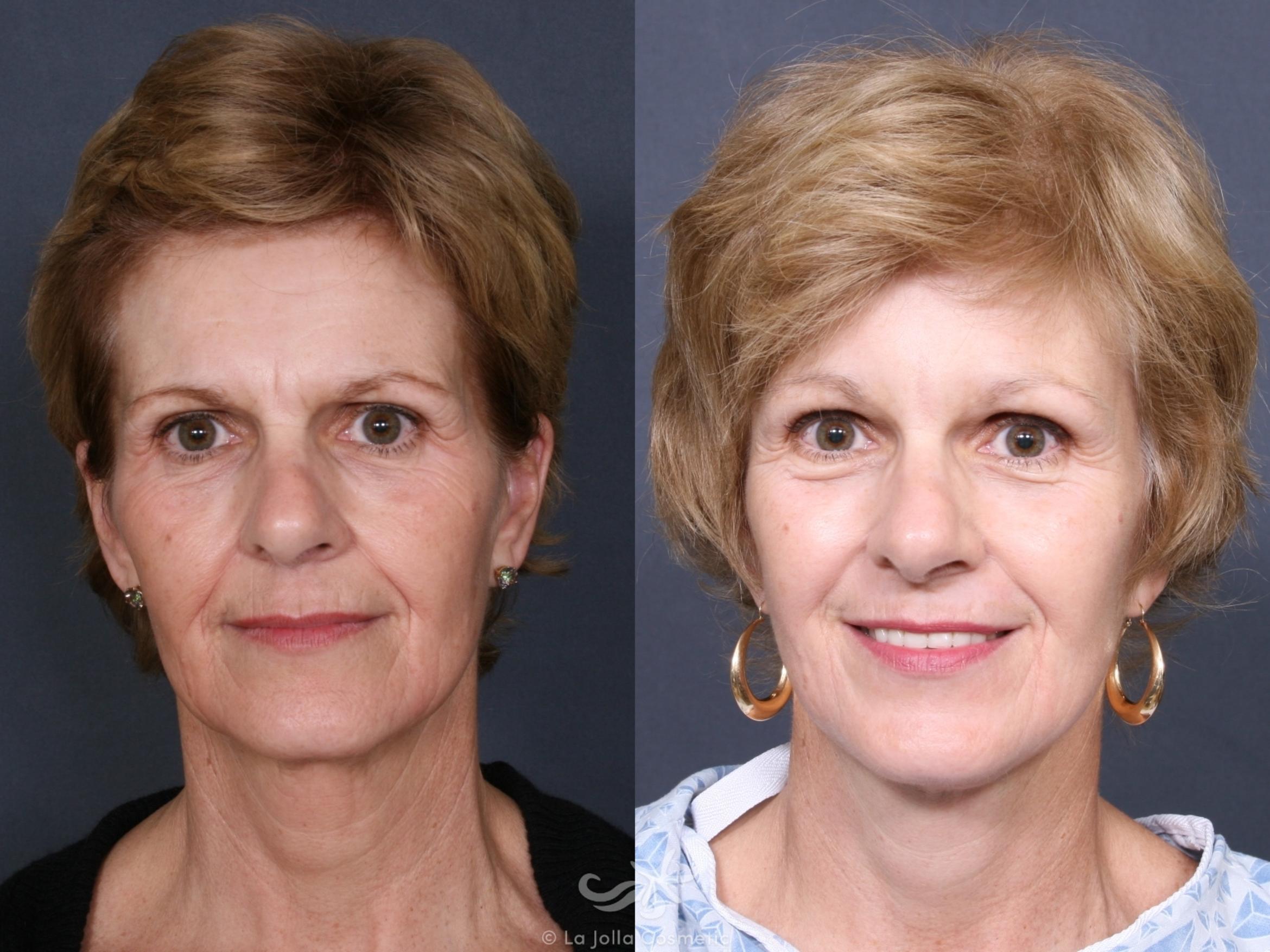 Before & After Facial Fat Transfer Result 473 Front View in San Diego, CA