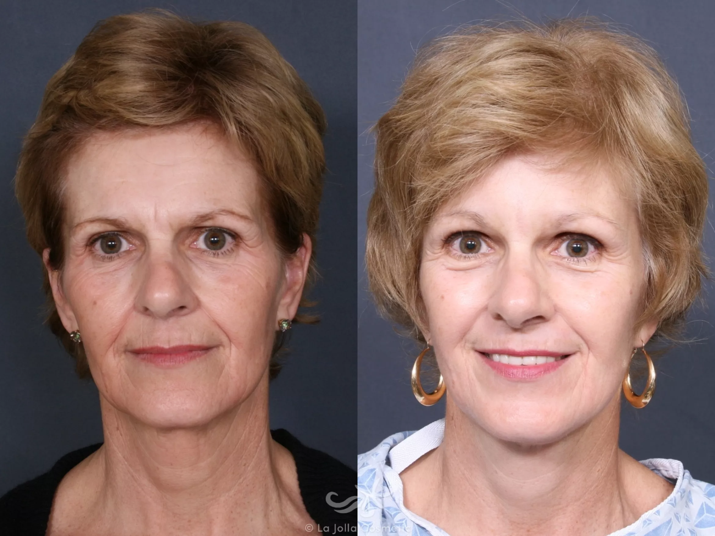 Before & After Facelift Result 473 Front View in San Diego, CA