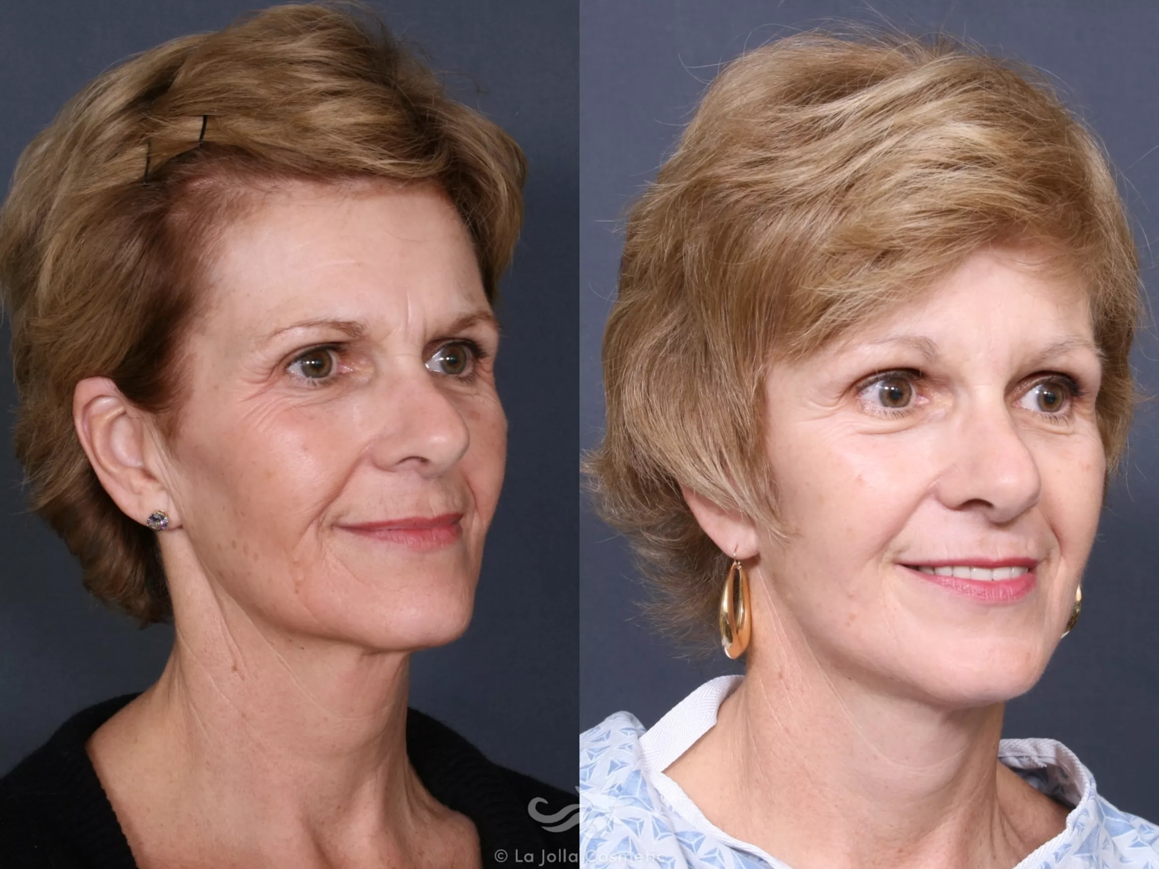 Before & After Facelift Result 473 Right Oblique View in San Diego, CA