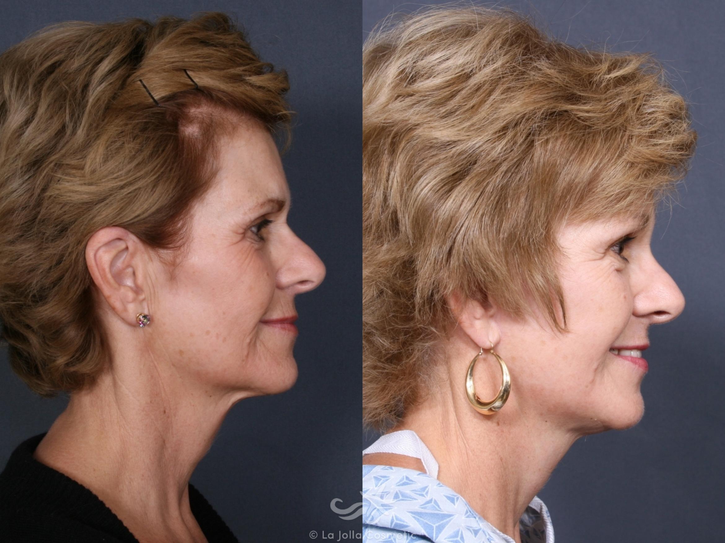 Before & After Facelift Result 473 Right Side View in San Diego, CA