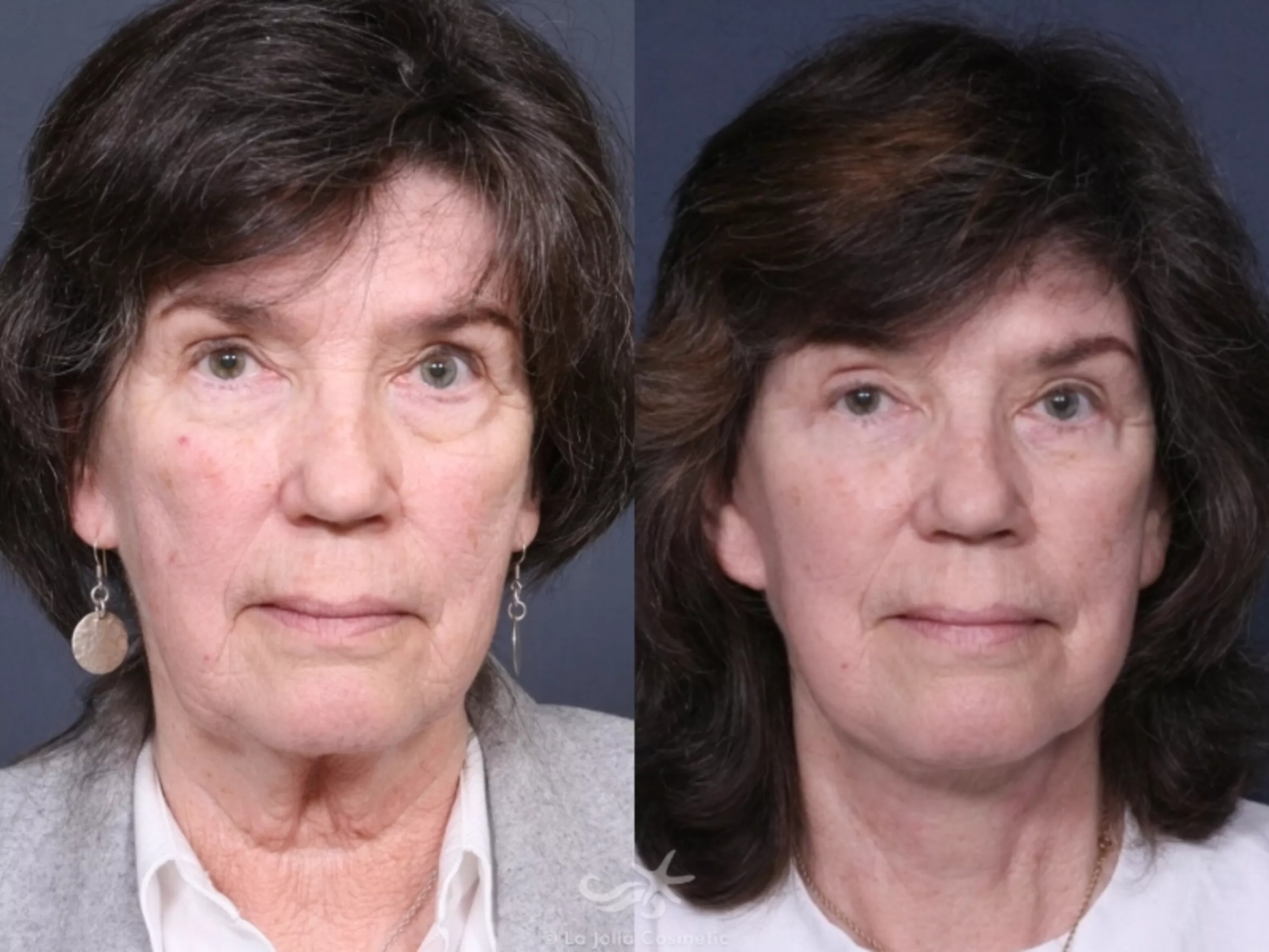 Before & After Facelift Result 475 Front View in San Diego, CA