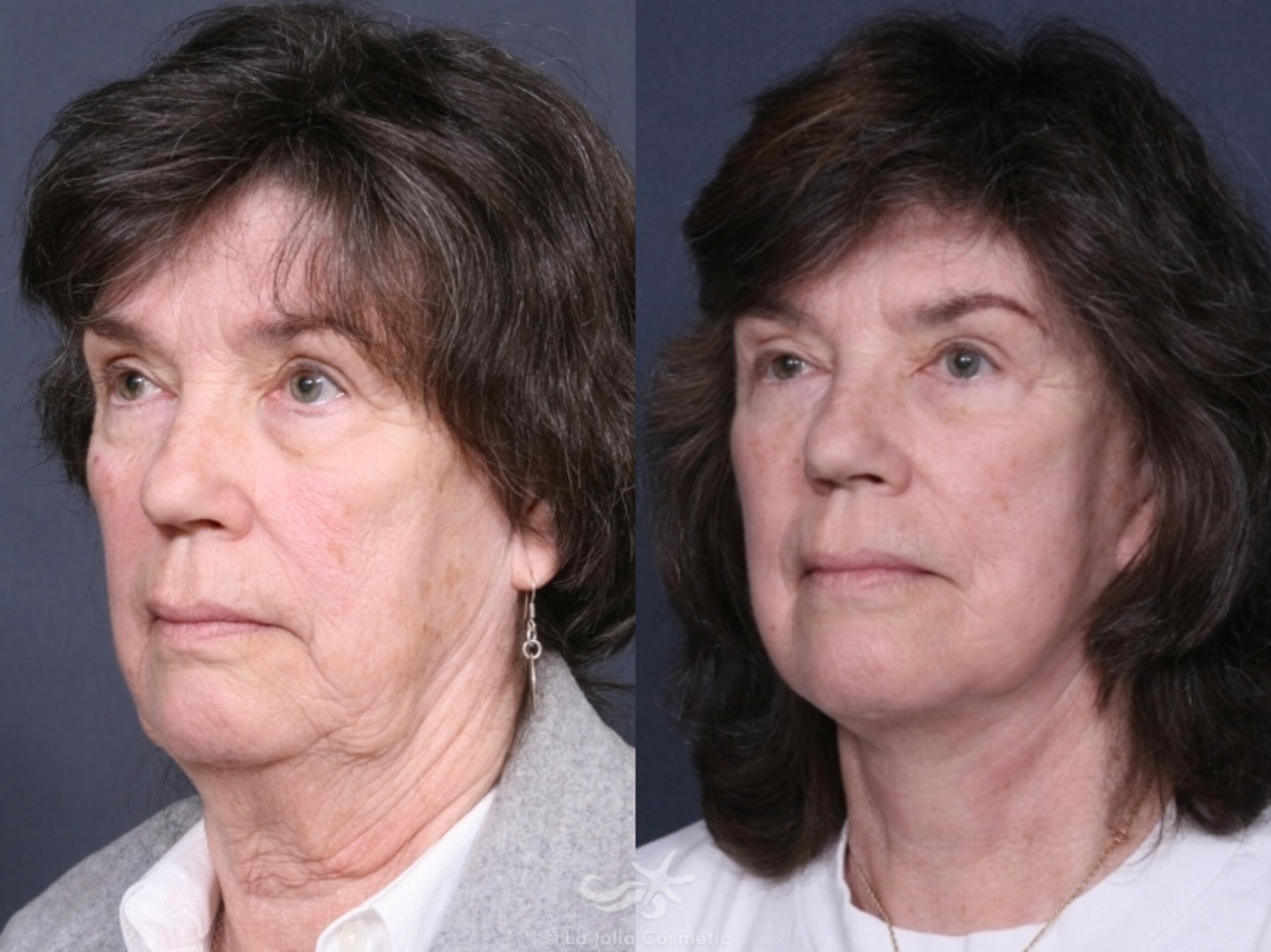 Before & After Facelift Result 475 Left Oblique View in San Diego, CA