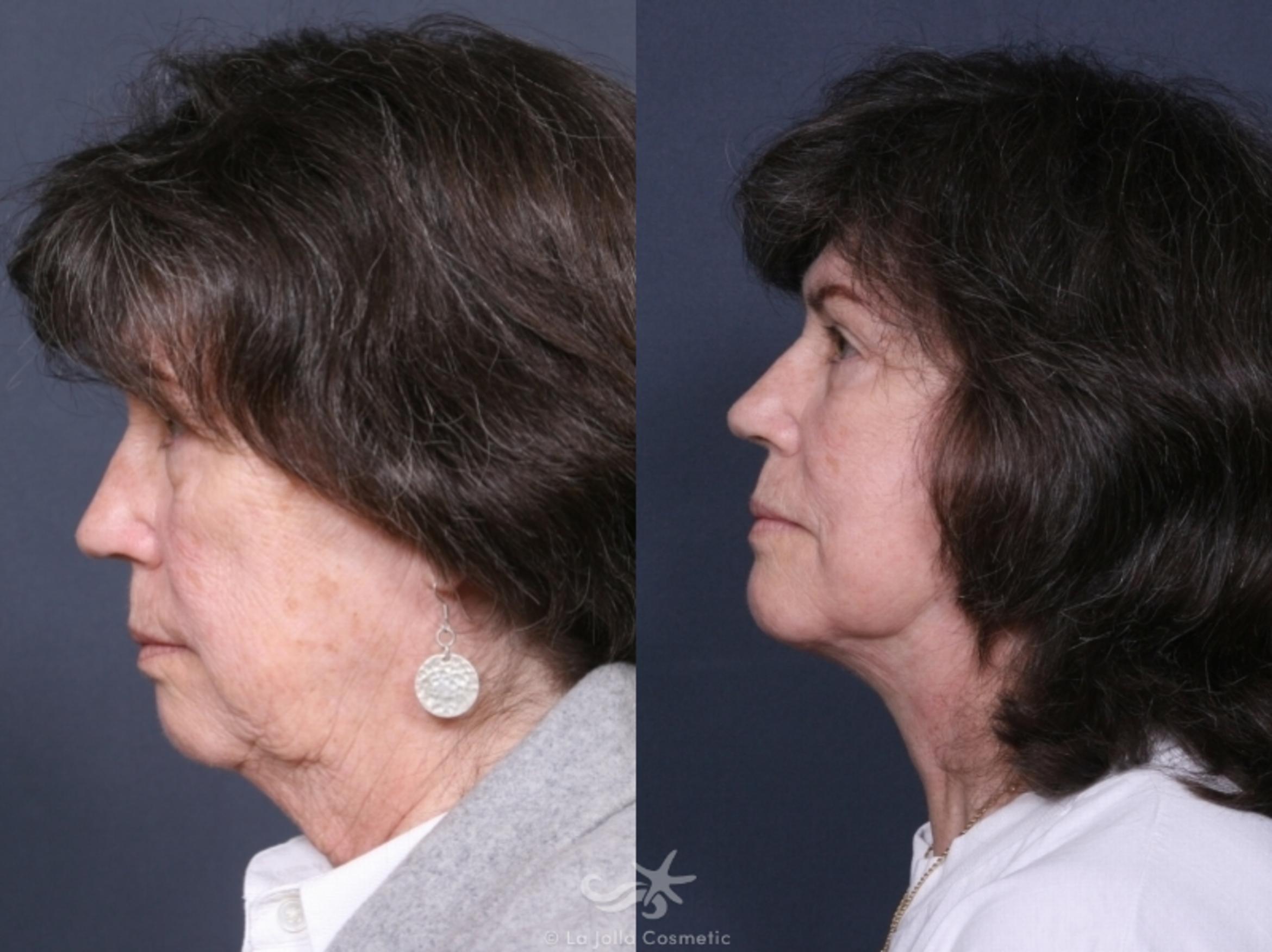 Before & After Facelift Result 475 Left Side View in San Diego, CA