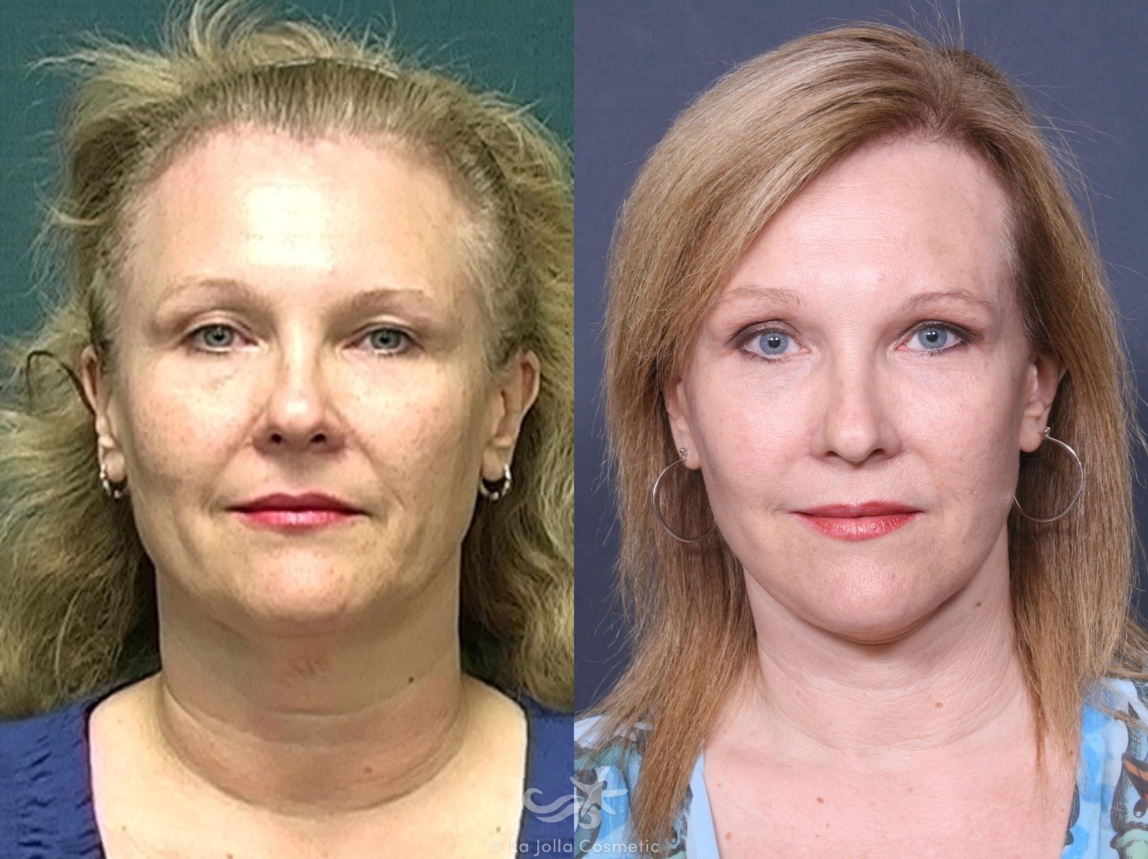 Before & After Facelift Result 479 Front View in San Diego, CA