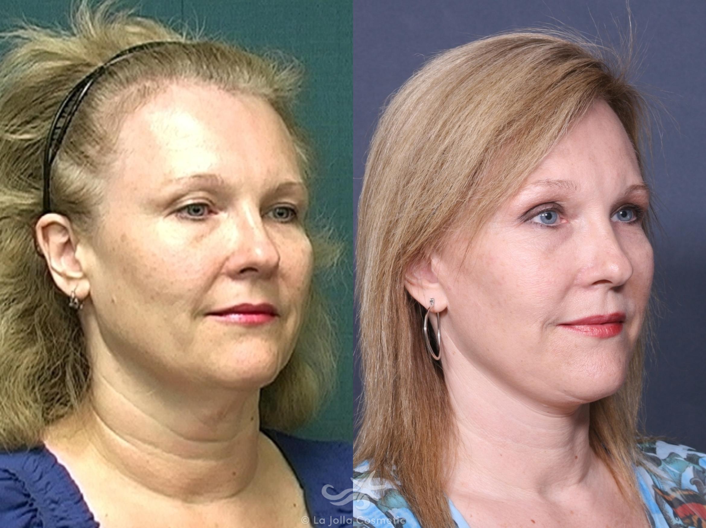 Before & After Facelift Result 479 Right Oblique View in San Diego, CA