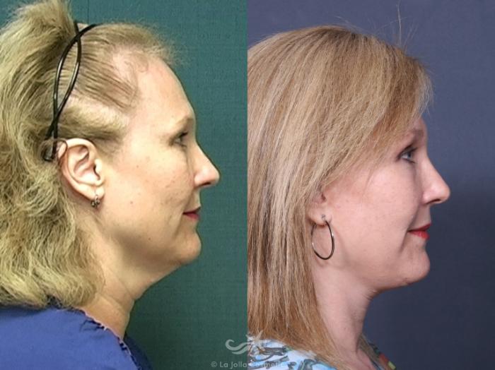 Before & After Facelift Result 479 Right Side View in San Diego, Carlsbad, CA