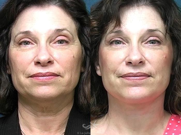 Before & After Facelift Result 486 Front View in San Diego, Carlsbad, CA