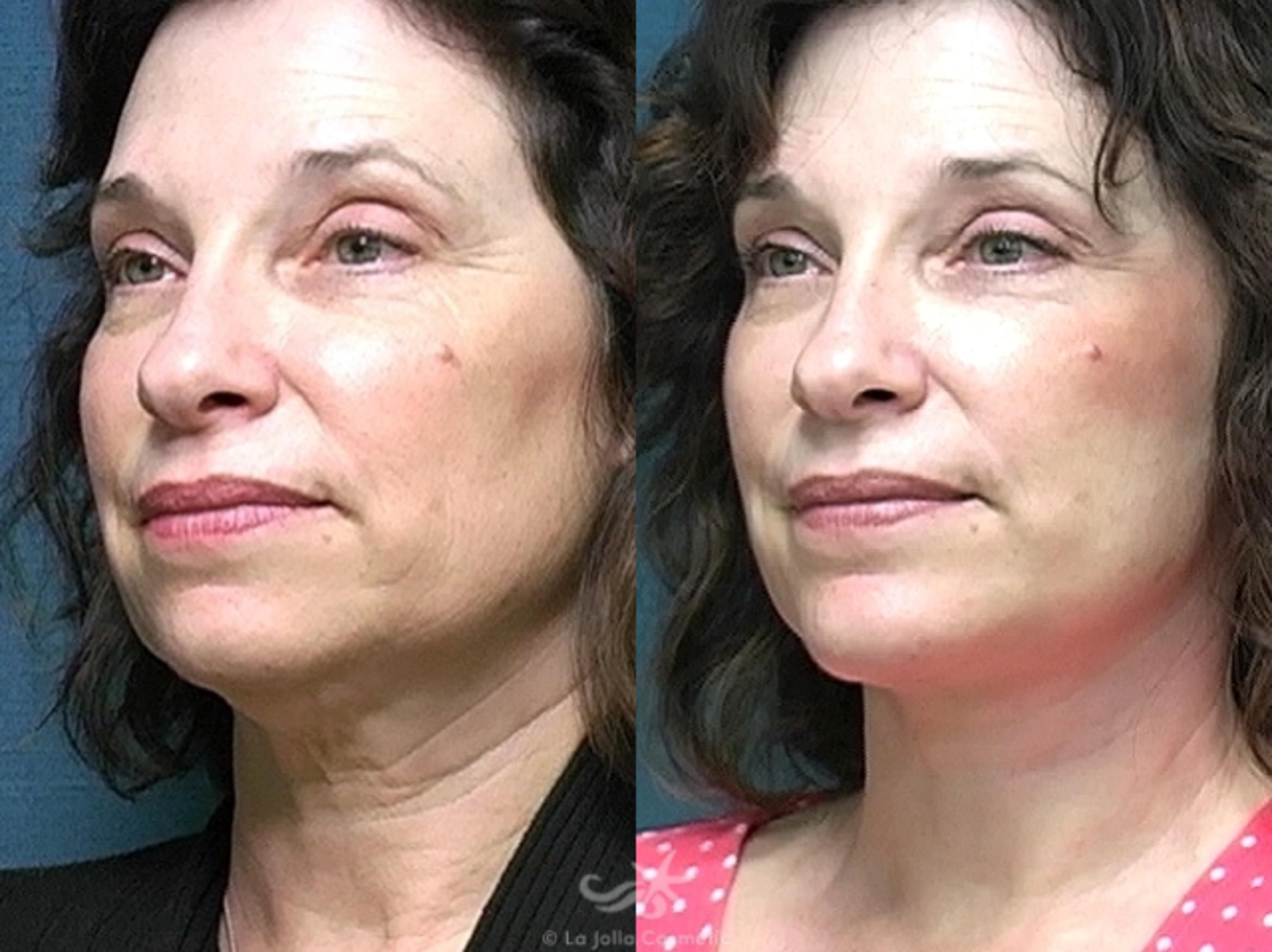 Before & After Facelift Result 486 Left Oblique View in San Diego, CA