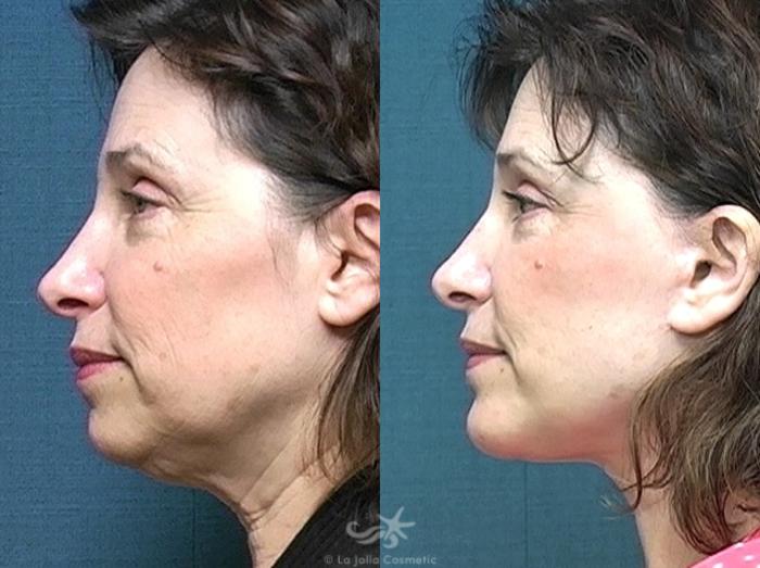 Before & After Facelift Result 486 Left Side View in San Diego, Carlsbad, CA