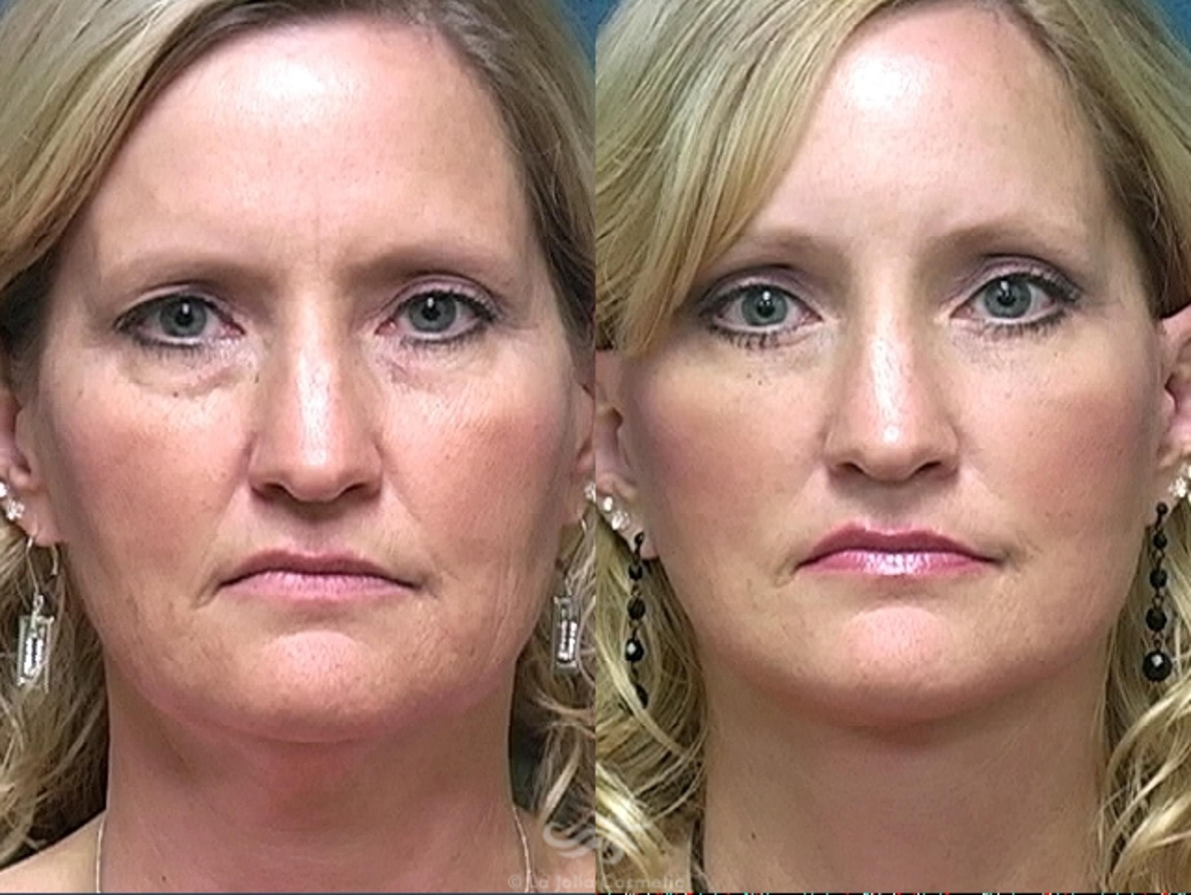 Before & After Facelift Result 489 Front View in San Diego, CA