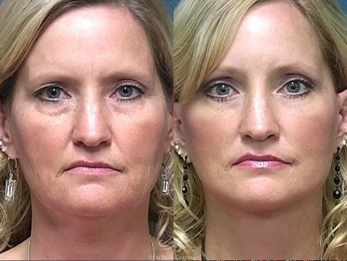 Before & After Facelift Result 489 Front View in San Diego, Carlsbad, CA