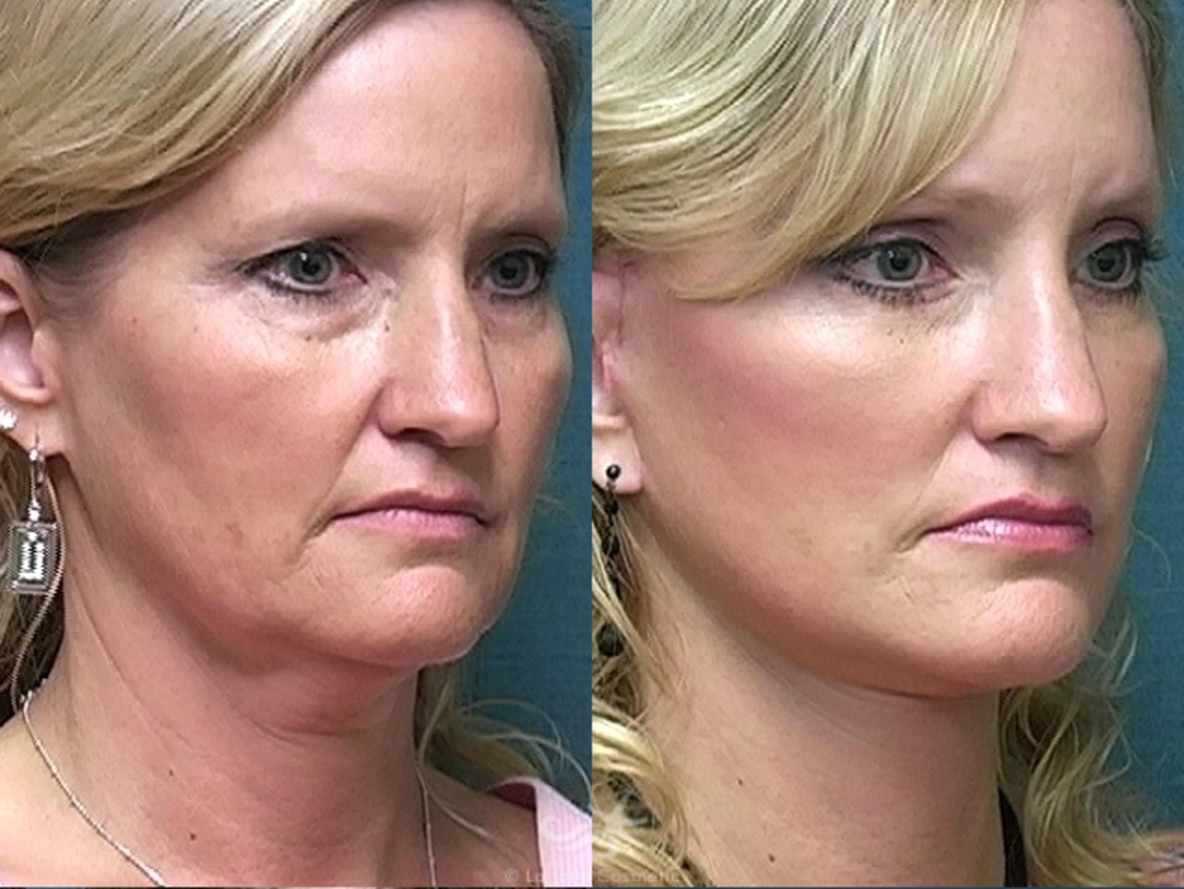 Before & After Facelift Result 489 Right Oblique View in San Diego, CA