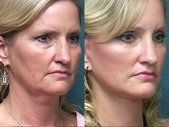 Before & After Facelift Result 489 Right Oblique View in San Diego, Carlsbad, CA