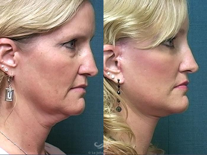 Before & After Facelift Result 489 Right Side View in San Diego, Carlsbad, CA