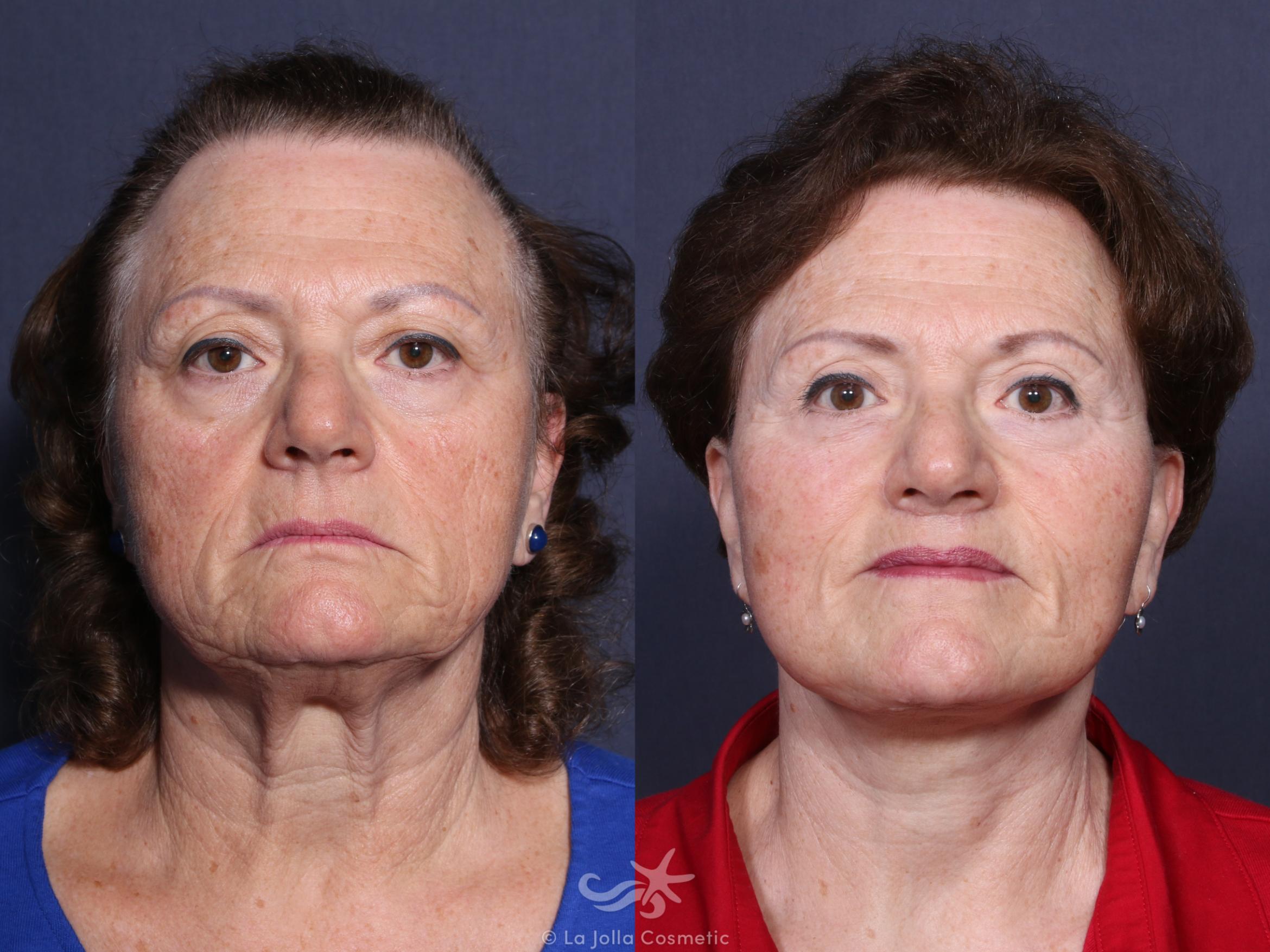 Before & After Facial Fat Transfer Result 49 Front View in San Diego, CA