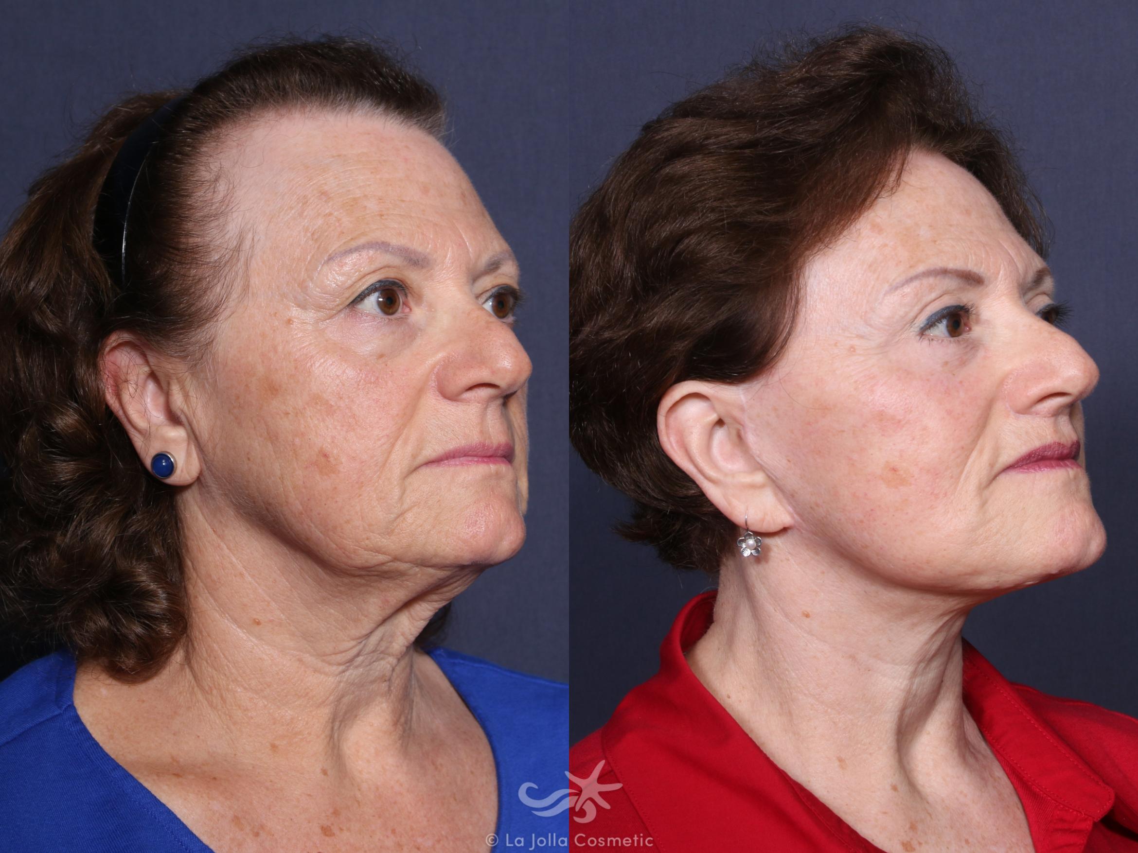 Before & After Lip Lift Result 49 Right Oblique View in San Diego, CA