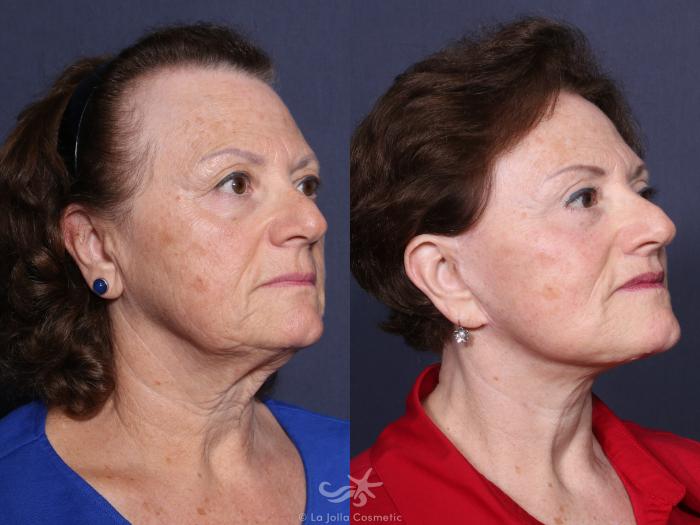 Before & After Facelift Result 49 Right Oblique View in San Diego, Carlsbad, CA