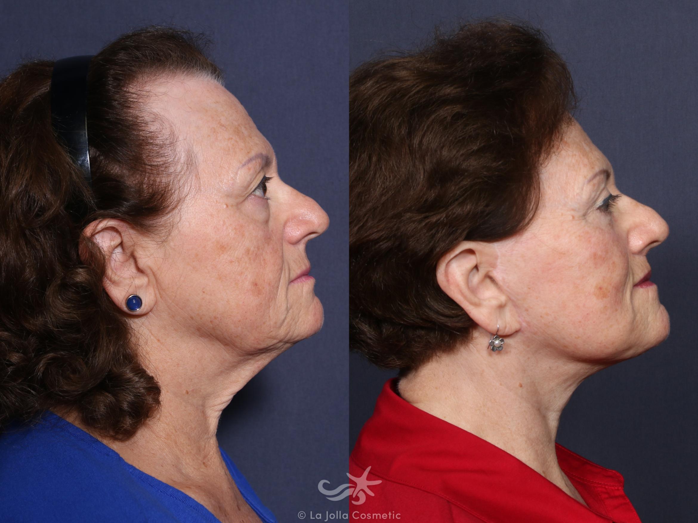 Before & After Lip Lift Result 49 Right Side View in San Diego, CA