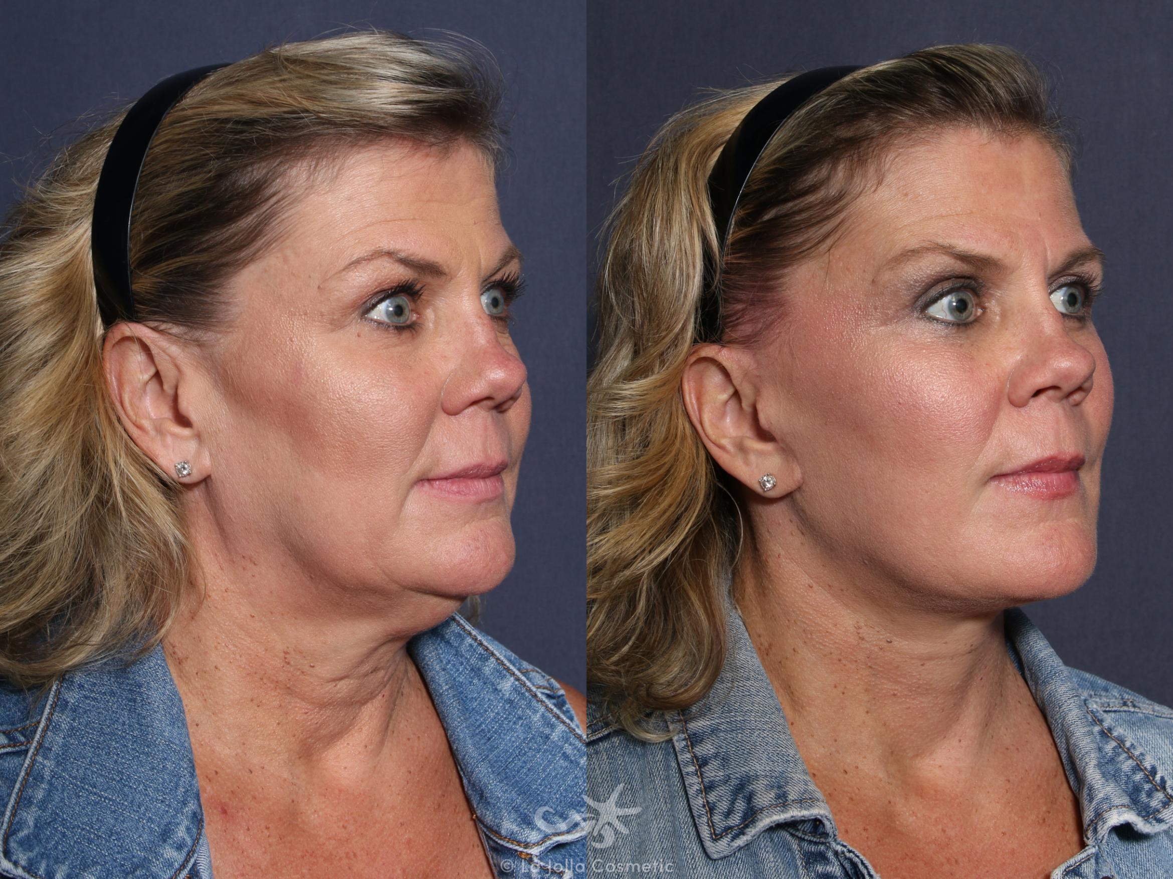 Before & After Eyelid Lift Result 50 Right Oblique View in San Diego, CA