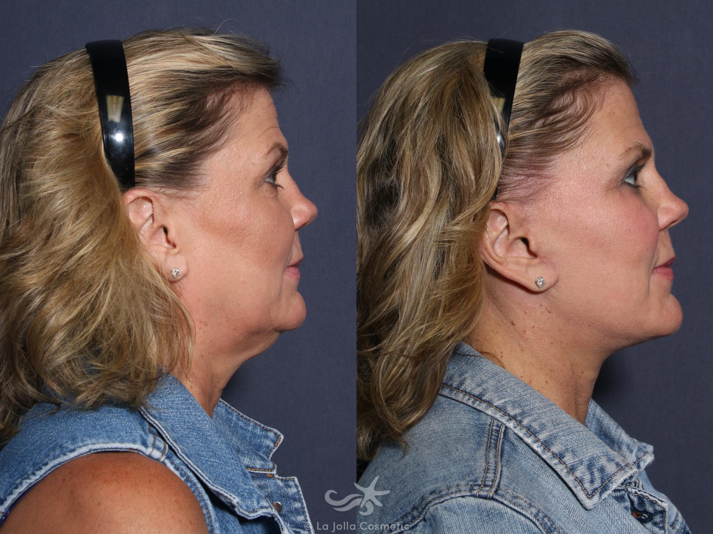 Before & After Facelift Result 50 Right Side View in San Diego, CA