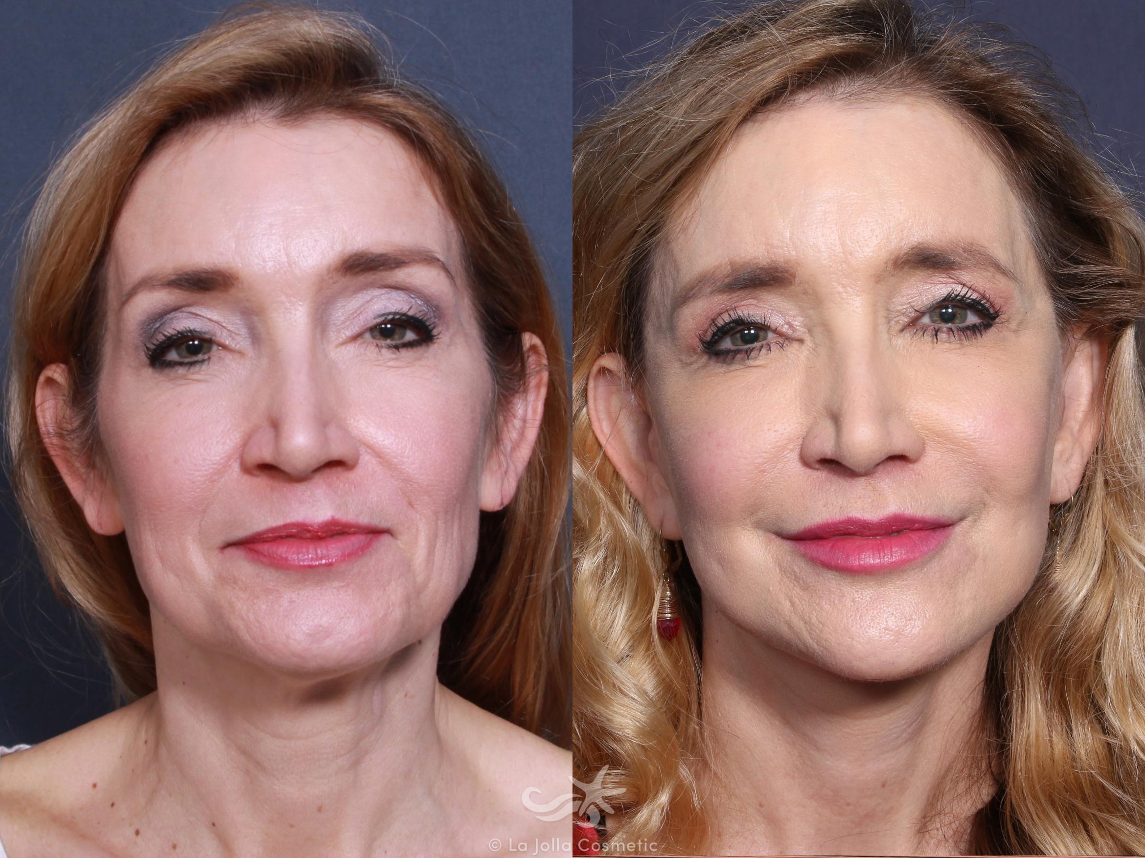 Before & After Facelift Result 504 Front View in San Diego, CA