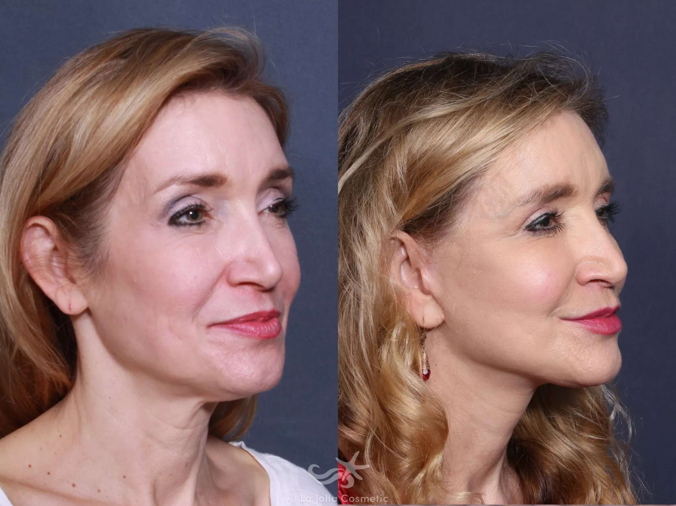 Before & After Facelift Result 504 Right Oblique View in San Diego, CA