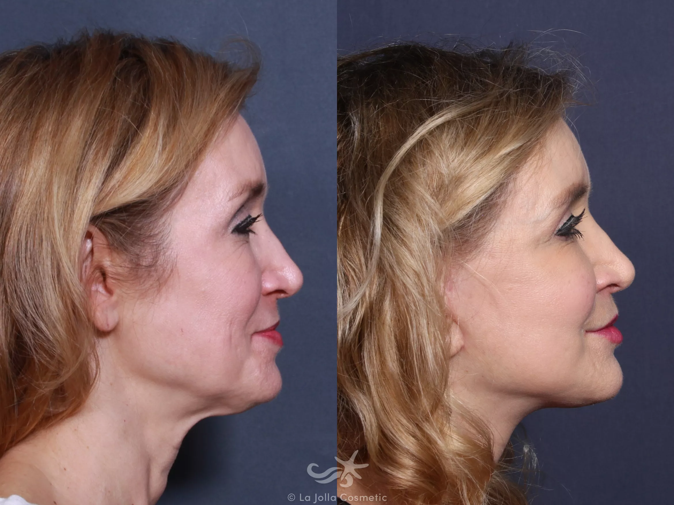Before & After Facelift Result 504 Right Side View in San Diego, CA