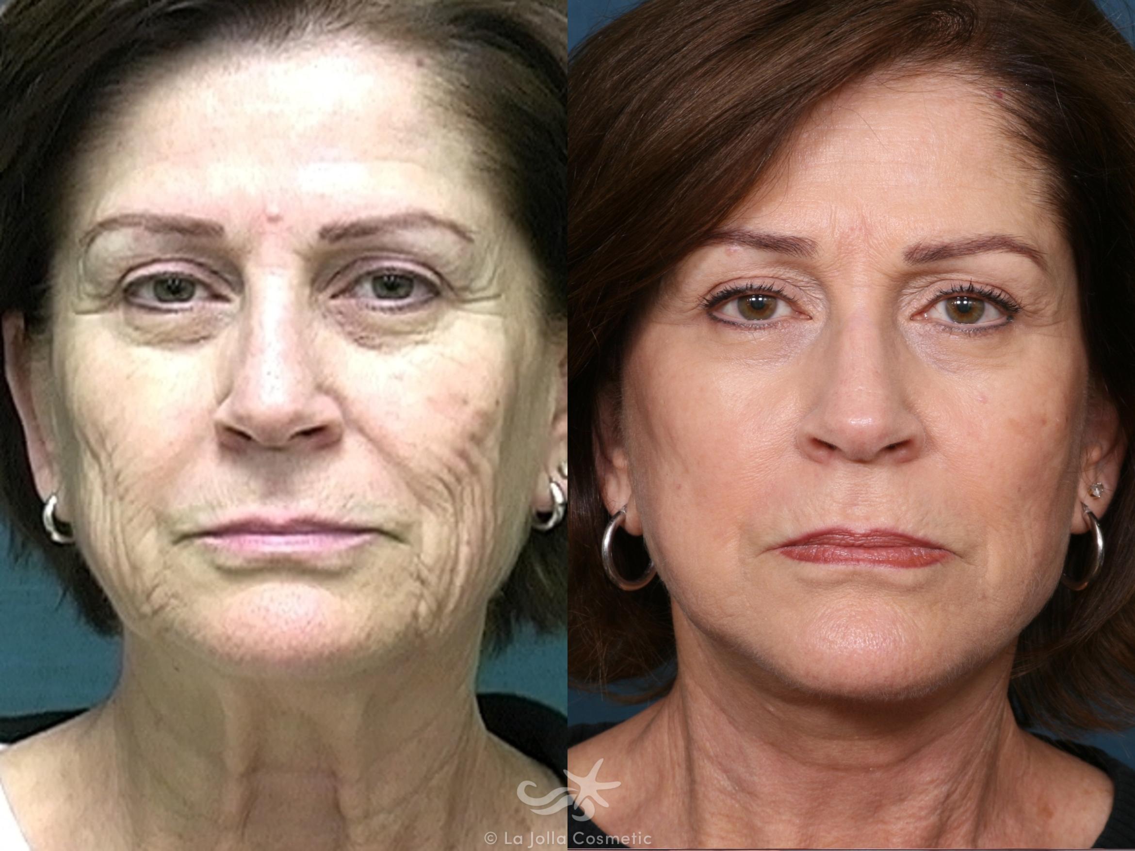 Before & After Facelift Result 513 Front View in San Diego, CA
