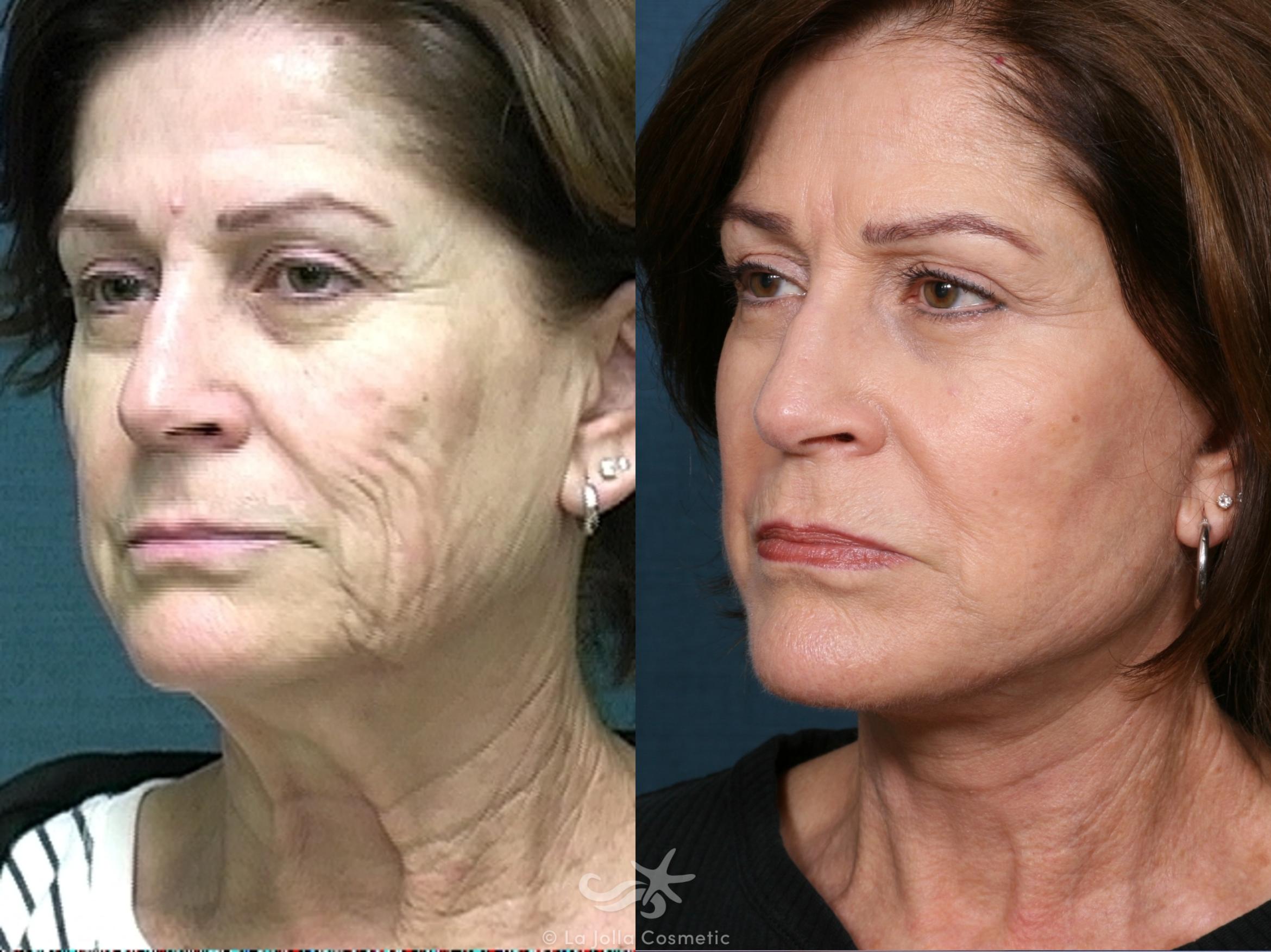 Before & After Facelift Result 513 Left Oblique View in San Diego, CA